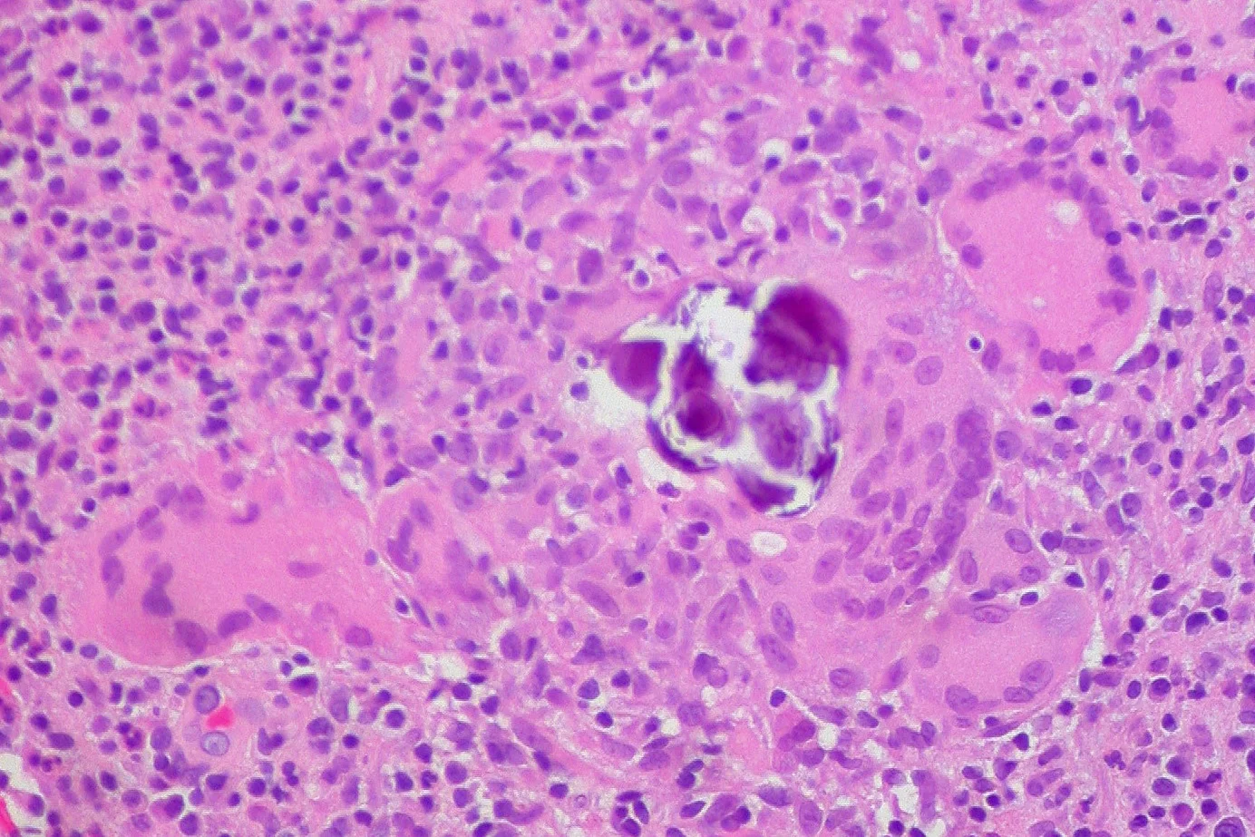 염증 반응 · Schaumann Body in Granuloma of Chalazion Pathological and histological images courtesy of Ed Uthman at flickr.