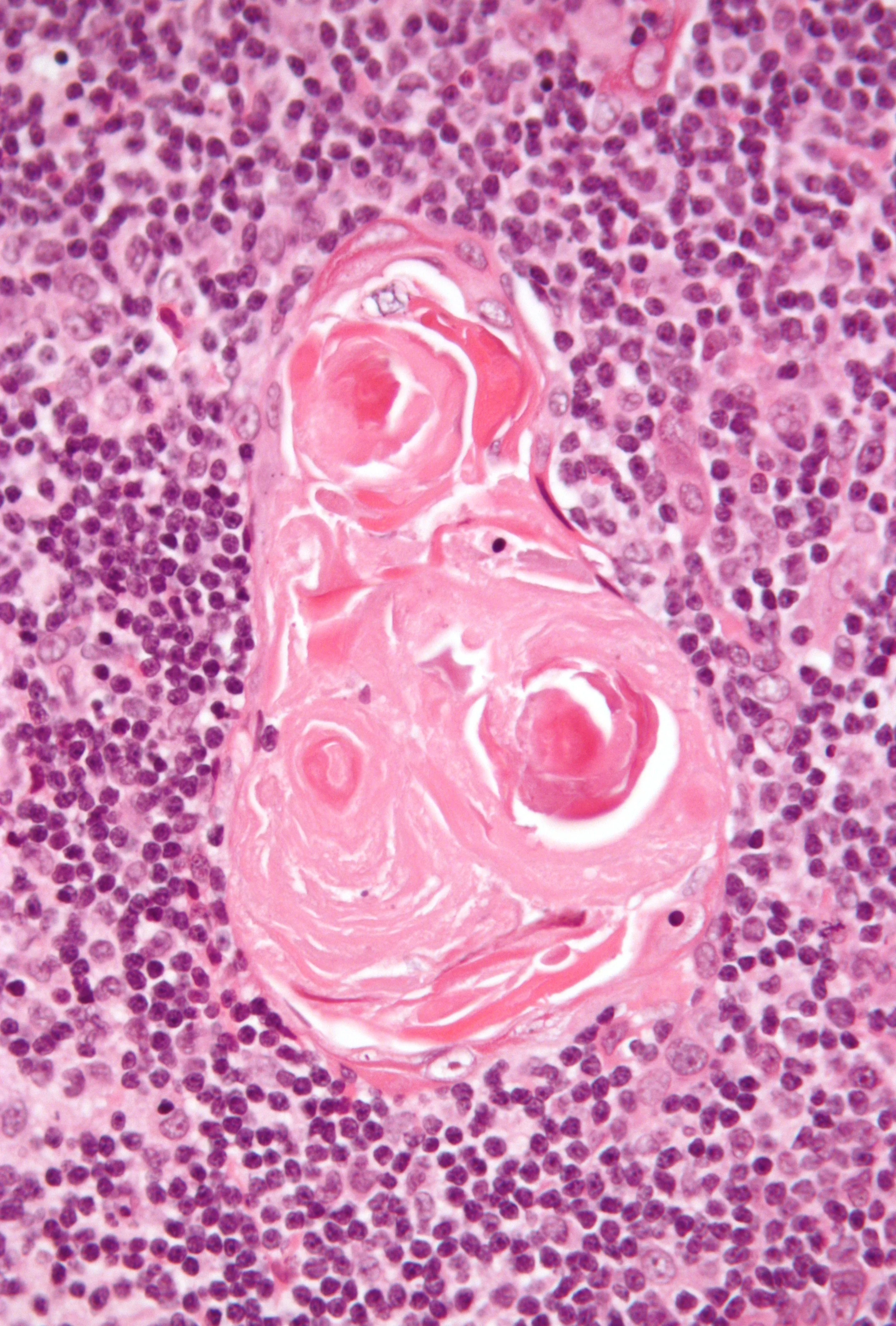 조직학 · Micrograph of the thymus showing a thymic corpuscle (Hassall's corpuscle). H&E stain .