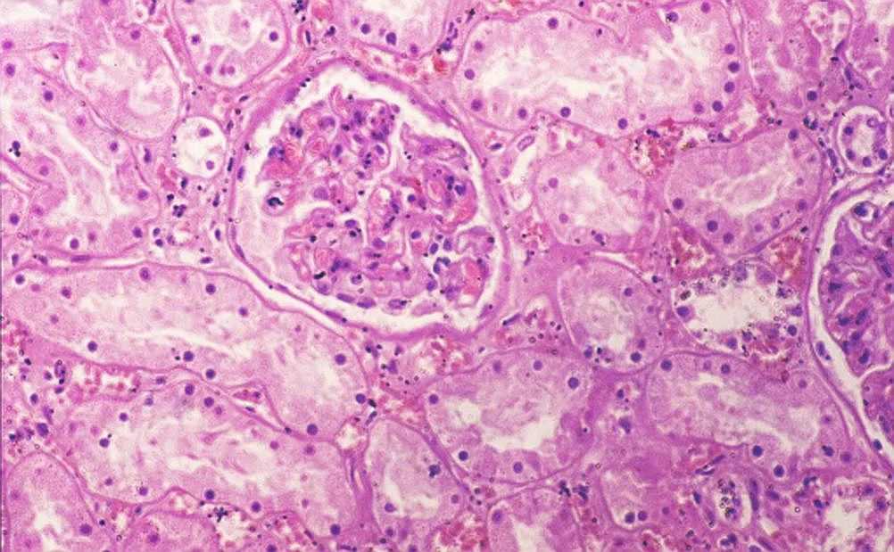 병리학 · Necrosi tubular aguda renal