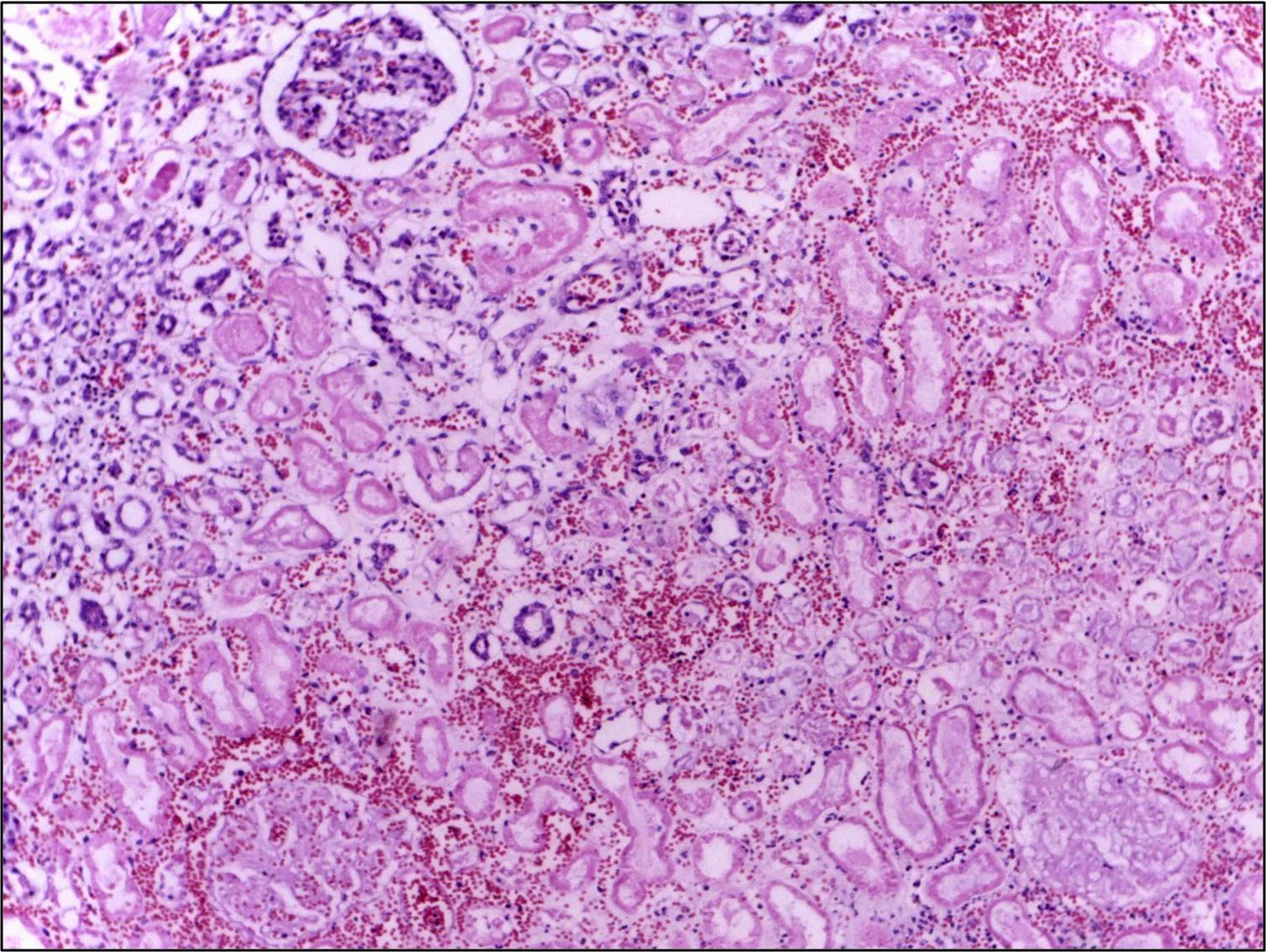 병리학 · Edge of infarct shows normal kidney (upper left) with necrotic tubules and glomeruli in the infarct area having preserved cellular outlines with loss of nuclei. Interstitial hemorrhage and mild 