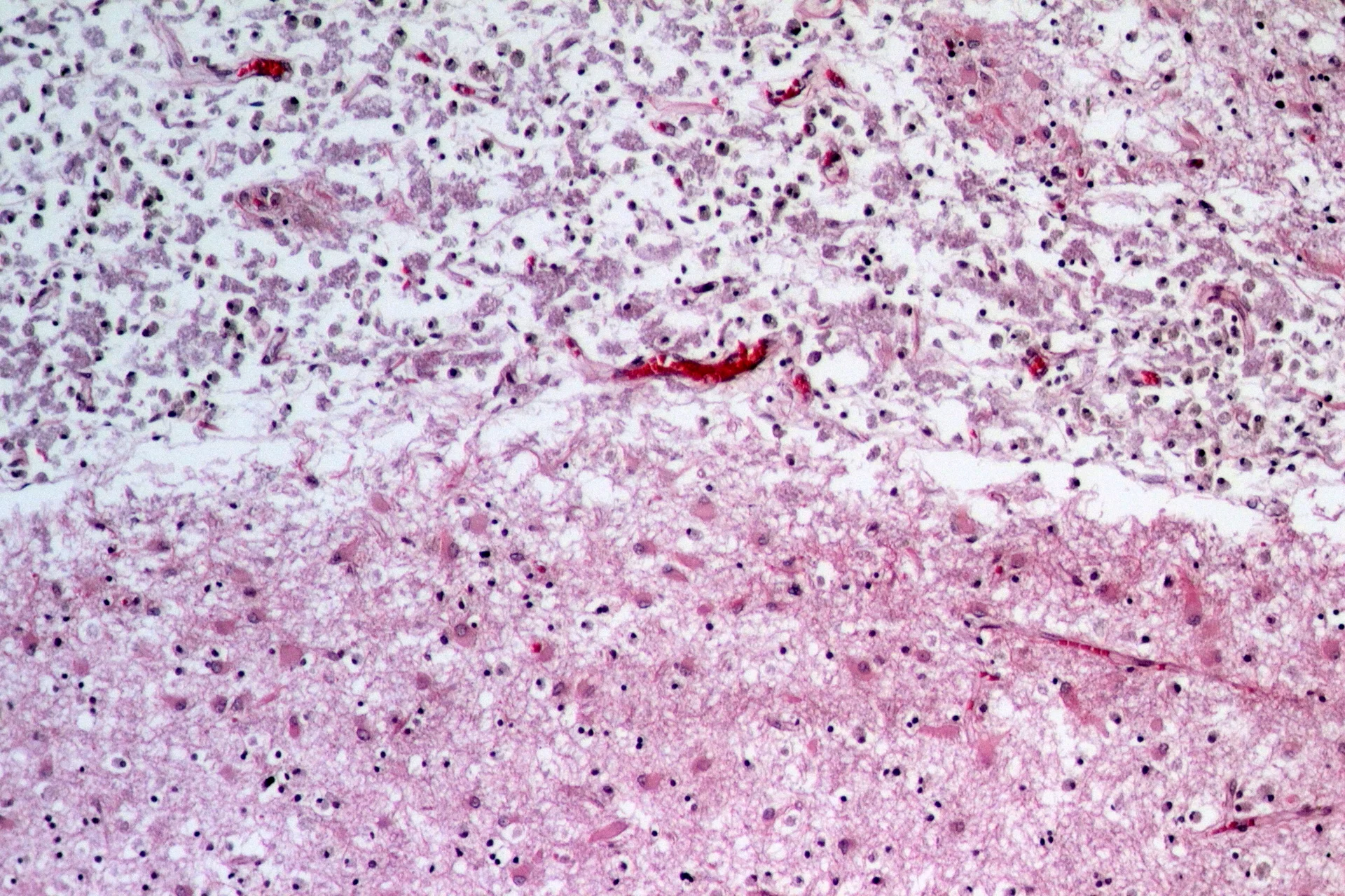 병리학 · Organizing ischemic cerebral infarction .