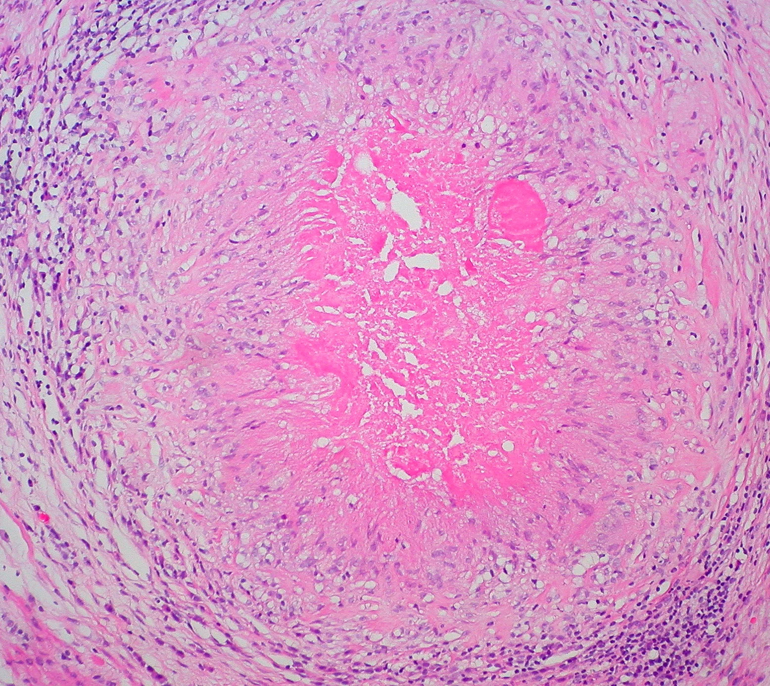 병리학 · Palisaded Granuloma Pathological and histological images courtesy of Ed Uthman at flickr.