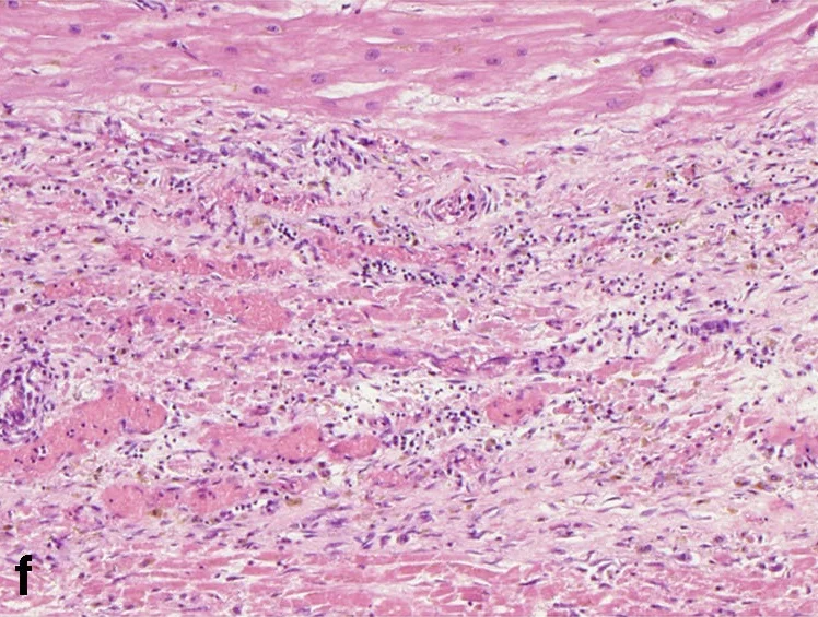 병리학 · Histological features of MI at different stages, without reperfusion; (a) myofiber waviness (b) interstitial oedema (c) hypereosinophilia and coagulative necrosis of cardiomyocytes (d) heavy gra