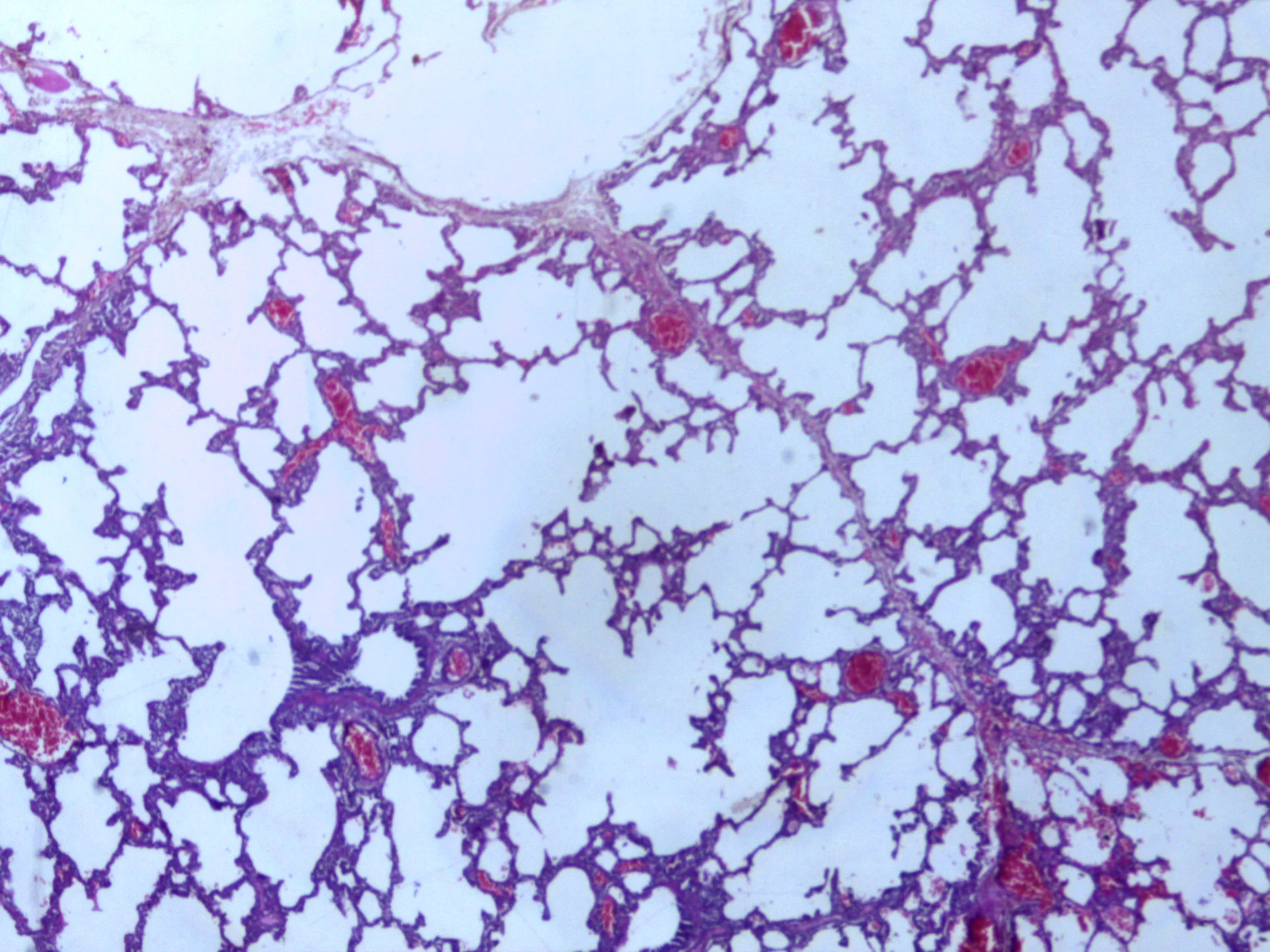 병리학 · Micrograph of empysema lung showing dialated, large alveoli separated by thin septa. Some septae are ruptured and appear to be floating in the alveloar spaces. Grossly emphysematous lung appears