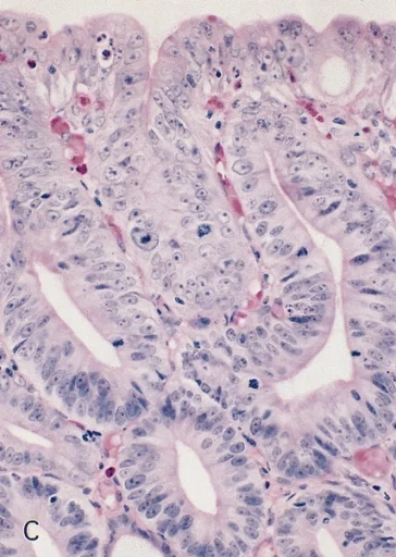 병리학 · ESOPHAGUS-STOMACH: BARRETT'S ESOPHAGUS WITH HIGH-GRADE DYSPLASIA: HISTOLOGIC SPECTRUM Another example of high-grade dysplasia demonstrating highly dysplastic cells similar to those described in 