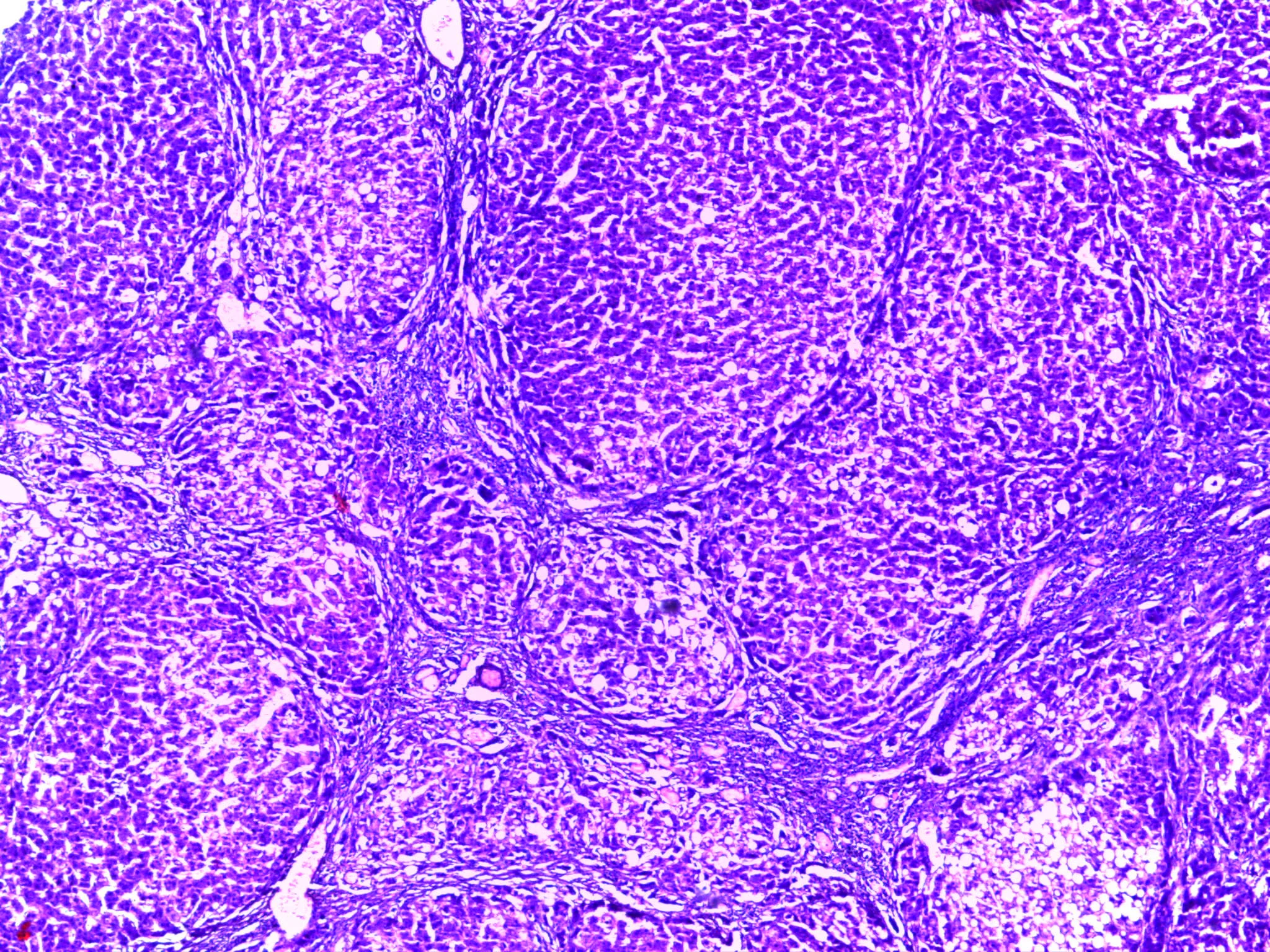 병리학 · Micrograph of liver showing nodules of parenchymal liver cells engulfed by broad bands of fibrous tissue. The liver has lost its normal architecture.