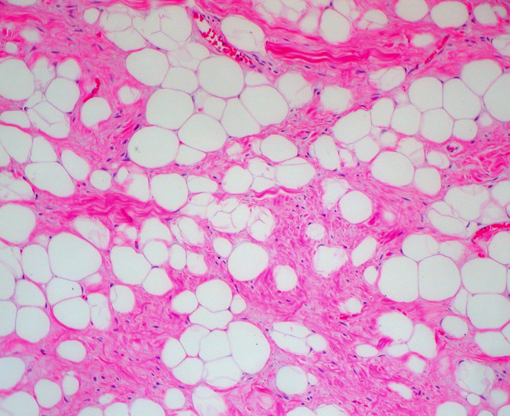 병리학 · From the subcutaneous tissue of the neck. Pathological and histological images courtesy of Ed Uthman at flickr.