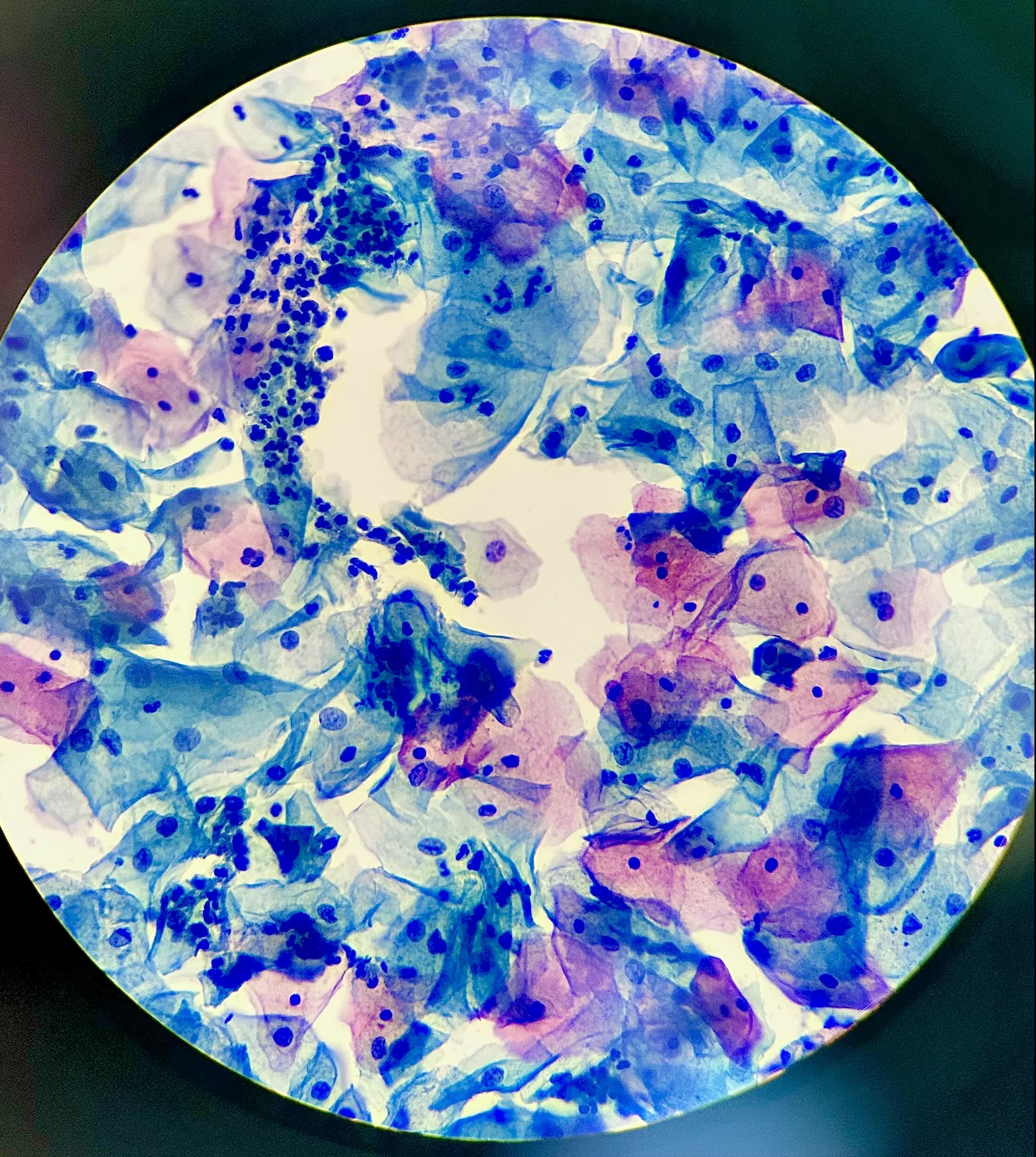 진단세포학 · Microscopic image of a cervical cytology smear stained by the Papanicolaou method, showing superficial and intermediate squamous epithelial cells with preserved nuclear morphology. The backgro