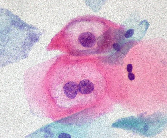 진단세포학 · Low-grade squamous intraepithelial lesion , abbreviated LSIL , with HPV effect. LSIL doesn't get much better than this! 35-year-old woman with ASC-US Pap one month ago. This is follow-up. Thin