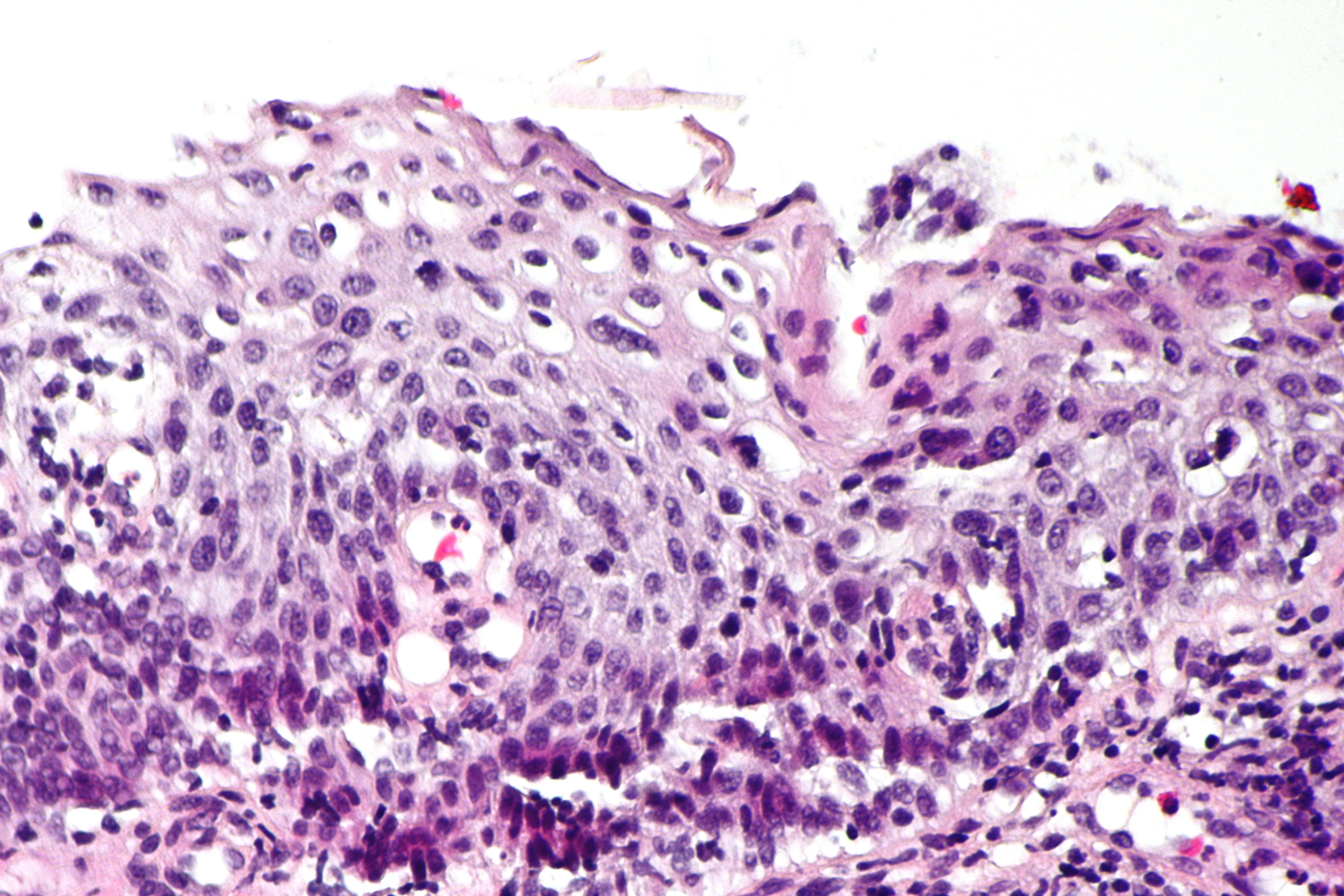 진단세포학 · Micrograph showing a high grade squamous intraepithelial lesion in a cervical biopsy. H&E stain /p16 IHC/p63 IHC/Ki-67 IHC. Related images HSIL - intermed. mag. HSIL - high mag. HSIL - very hi
