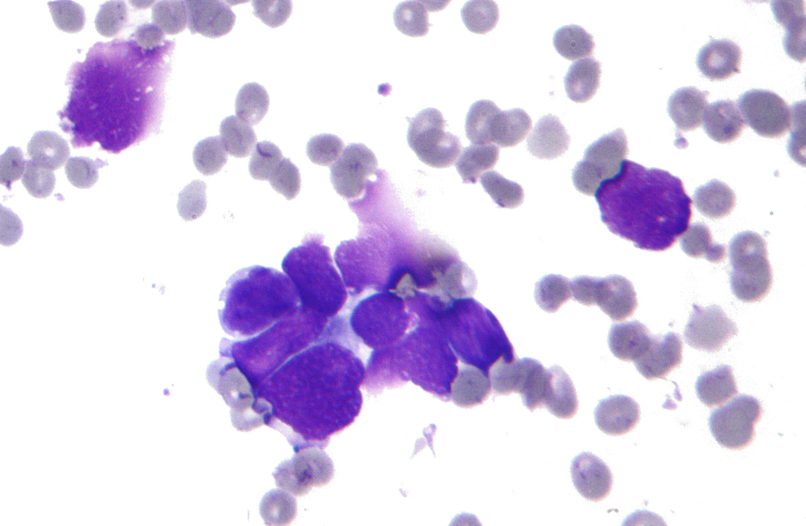 진단세포학 · Micrograph of small cell carinoma of the lung , also small cell lung cancer . FNA specimen . Field stain . The image shows the key features of small cell lung cancer (SCLC): Nuclear moulding. 