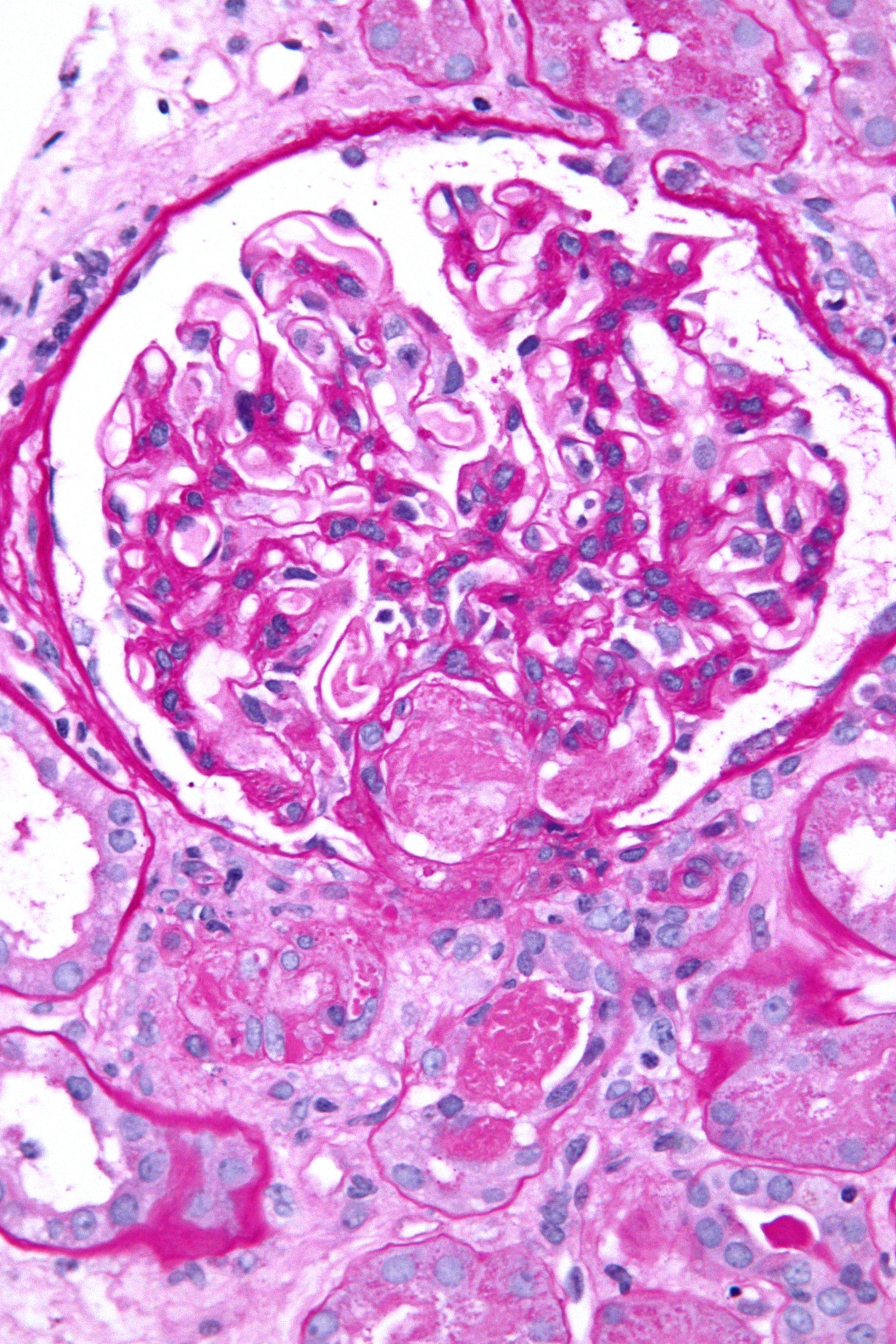 조직검사학 · Very high magnification micrograph of acute thrombotic microangiopathy , abbreviated TMA . Kidney biopsy . PAS stain . The differential diagnosis of TMA includes: [ 1 ] Hemolytic uremic syndro