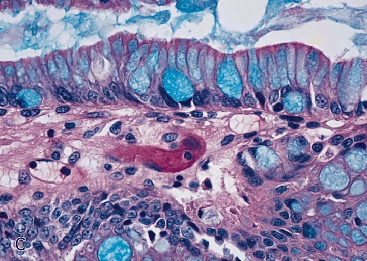 조직검사학 · ESOPHAGUS-STOMACH: MUCIN STAINS OF BARRETT'S MUCOSA High-power magnification shows the blue-staining goblet and columnar cells.