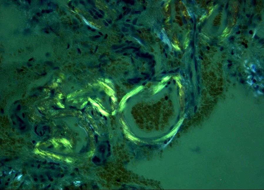 조직검사학 · Histopathology of cerebral amyloid angiopathy. Deposition of amyloid in hyalinized vessel wall on congo-red staining and Birefringence in polarized light.