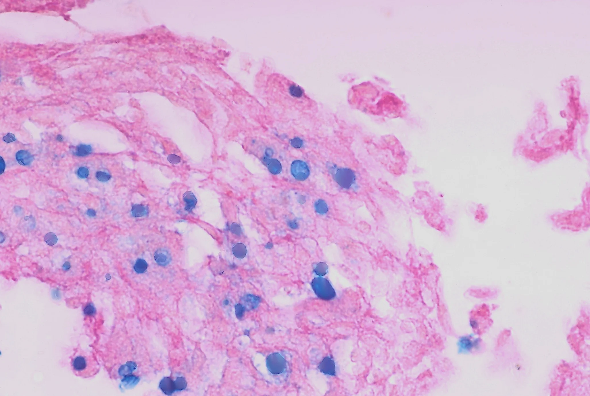 조직검사학 · Malakoplakia, a condition often associated with immunodeficiency and characterized by abnormal macrophage function consists of sheets of large histiocytes in response to a bacterial infection.
