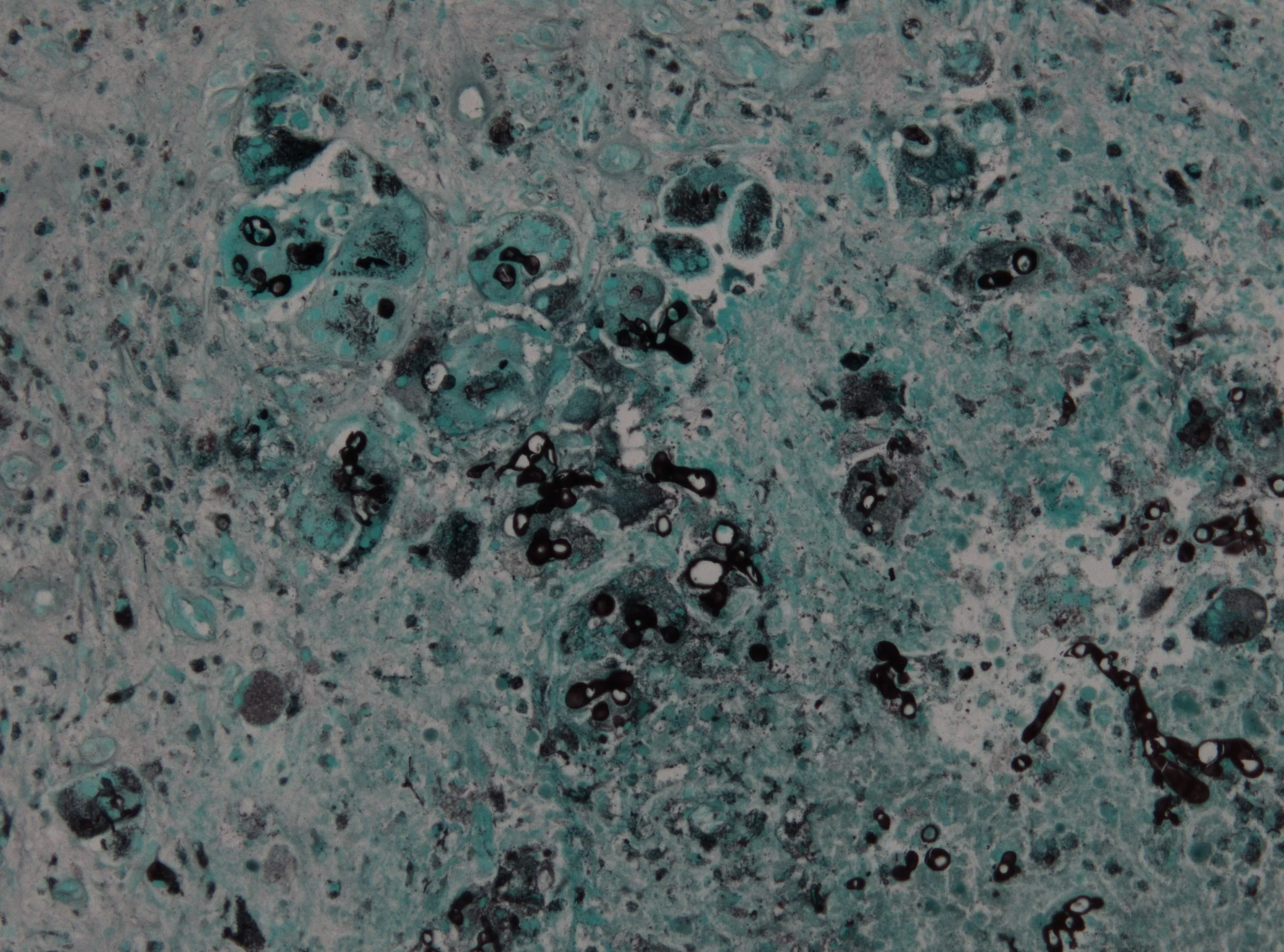 조직검사학 · Cerebral aspergillosis. Phagocytosis of fungi through macrophages in non-immuncompromised patient (Grocott stain).
