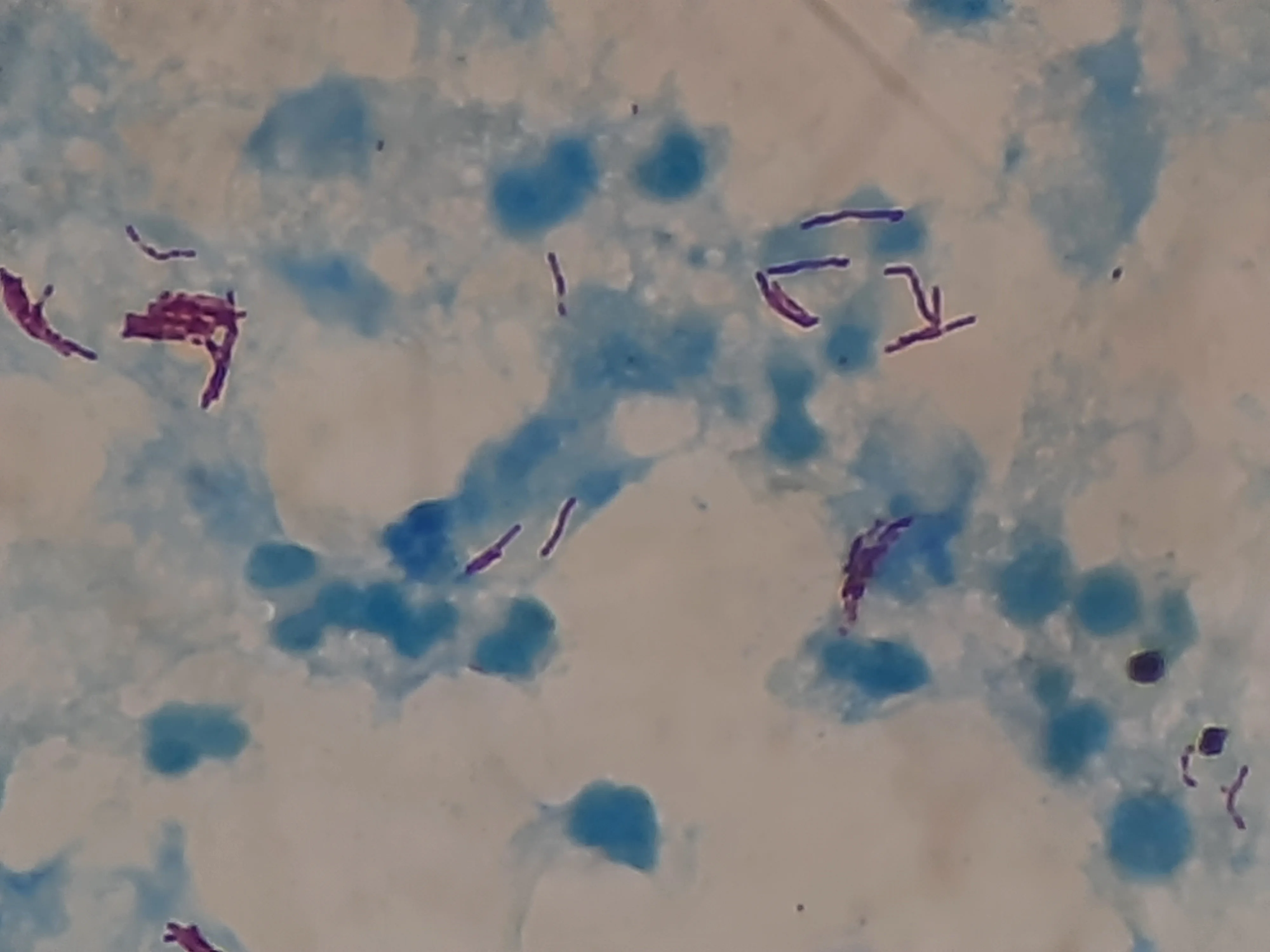 조직검사학 · Acid fast bacilli of Mycobacterium tuberculosis in Ziehl-Neelsen staining of BAL fluid