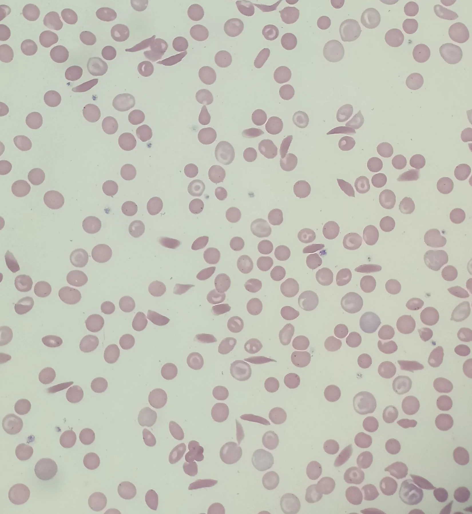 sickle cells peripheral blood smear · Blood smear from a patient with sickle cell anemia displaying sickle cells, polychromasia, and target cells