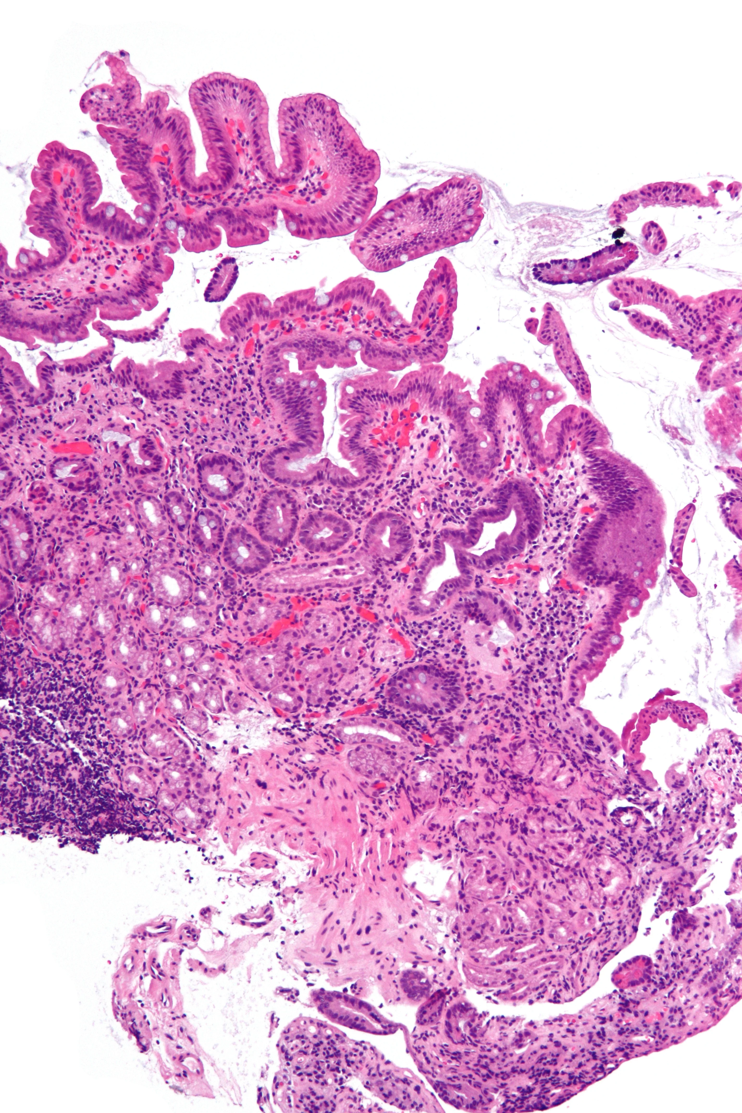 조직학 · Intermediate magnification micrograph of duodenum with foveolar metaplasia and mucosal Brunner's glands. H&E stain . Foveolar metaplasia historically has been associated with Helicobacter gastri