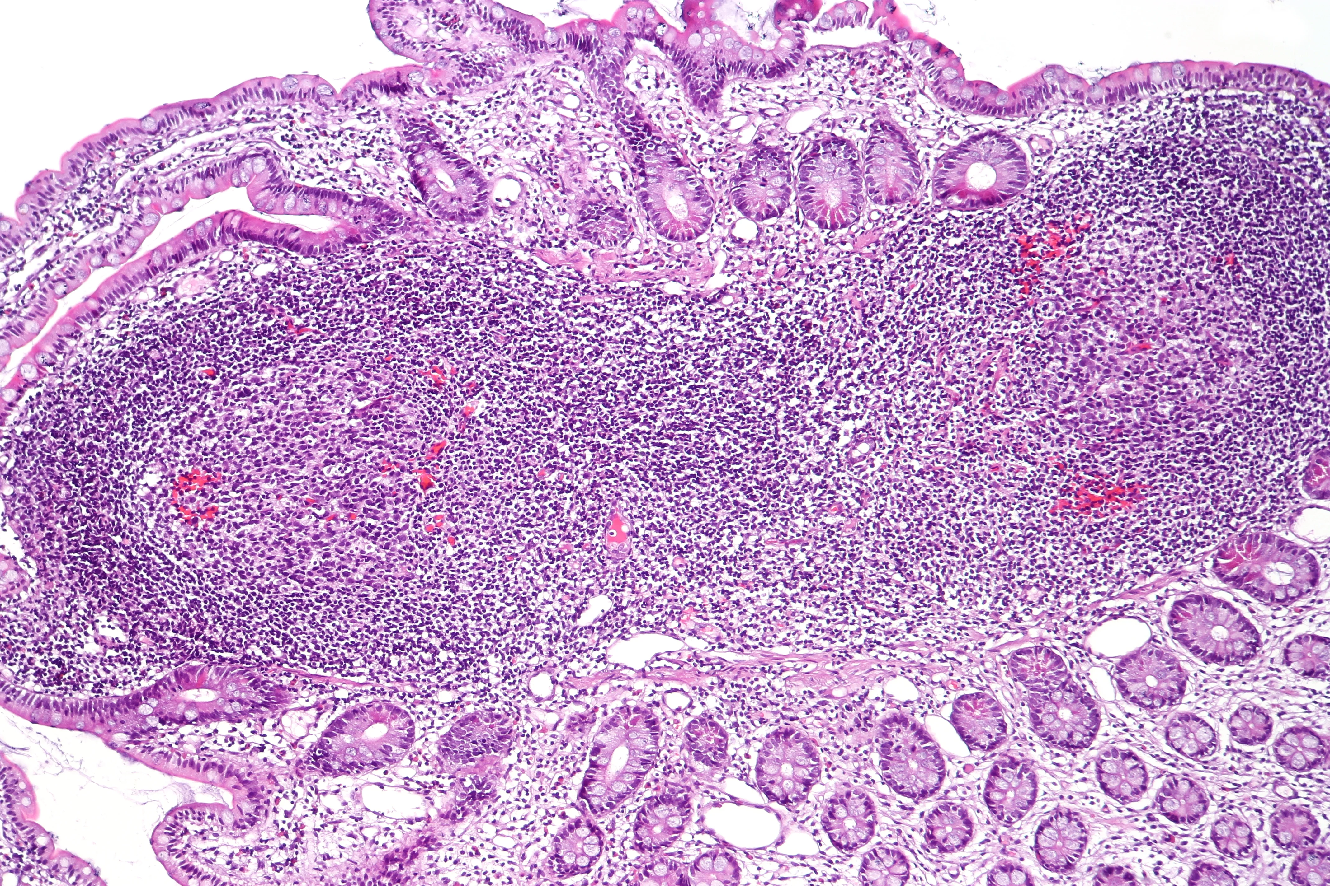 조직학 · Biopsy of terminal ileum showing normal histology and a lymphoid aggregate of Peyer's patch with two secondary lymphoid follicles. H&E Stain.