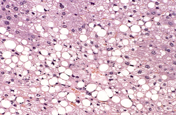 병리학 · Histological section of a murine liver showing severe steatosis. The clear vacuoles would have contained lipid in the living cells, however the histological fixation caused it to be dissolved an