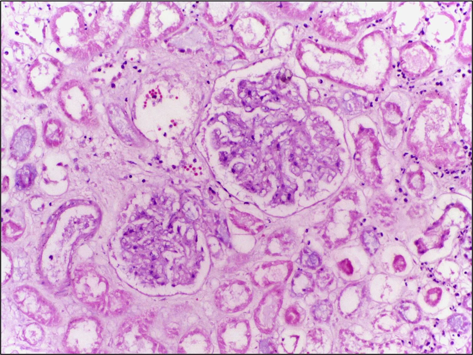 병리학 · Section from infarcted area of kidney showing necrotic tubules and glomeruli having preserved cellular outlines with loss of nuclei. [H&E stain, 40X]