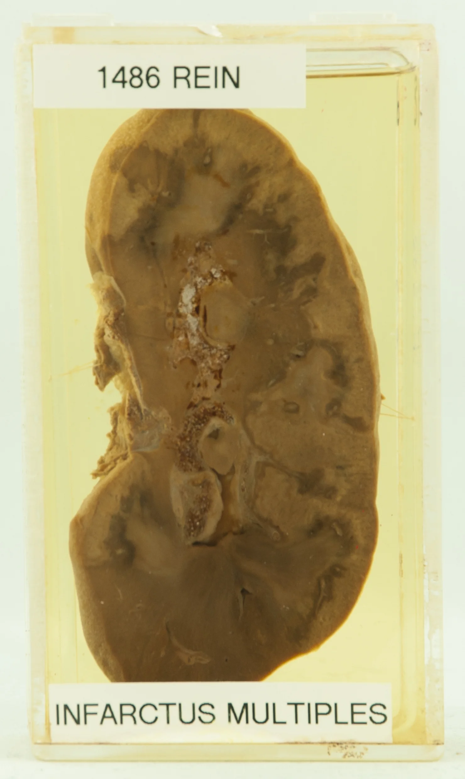 병리학 · Diagnostic original : Infarctus. Diagnostic actualisé : Infarctus rénal. Histoire : Femme de 70 ans décédée des suites d'une amputation du membre inférieur gauche. Description macroscopie : Plus