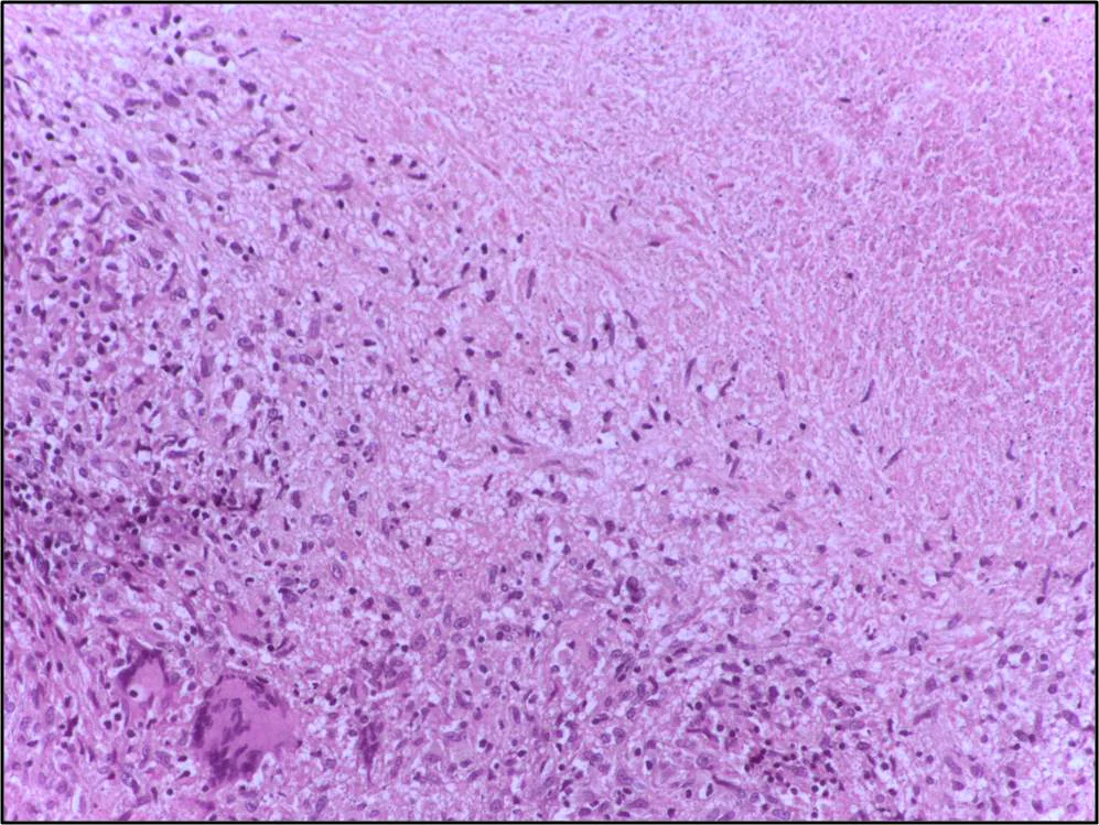 병리학 · Caseating granulomatous lesion with areas of amorphous granular eosinophilic necrotic debris known as caseation (on the right half) bordered by collections of epitheloid cells, Langhan giant cel