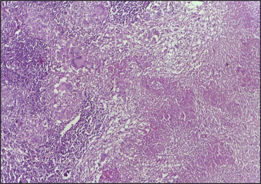 병리학 · Caseating granulomatous lesion with areas of amorphous granular eosinophilic necrotic debris known as caseation (on the right half) bordered by collections of epitheloid cells, Langhan giant cel