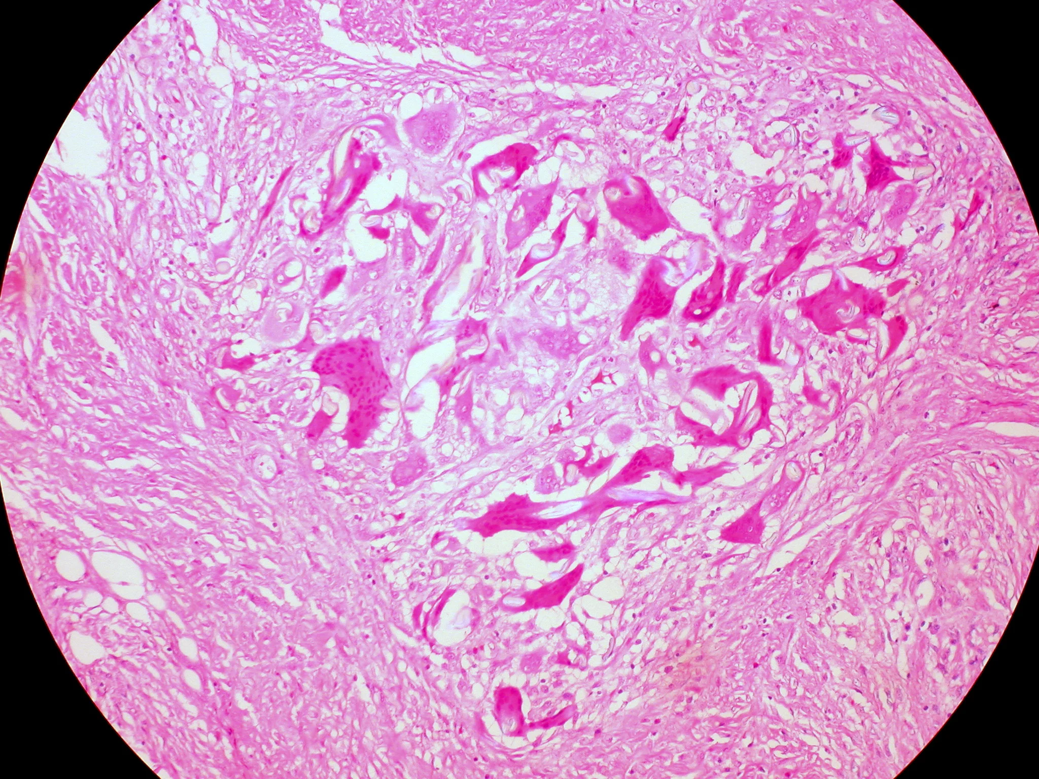 병리학 · Suture Granuloma, Abdominal Wall Pathological and histological images courtesy of Ed Uthman at flickr.