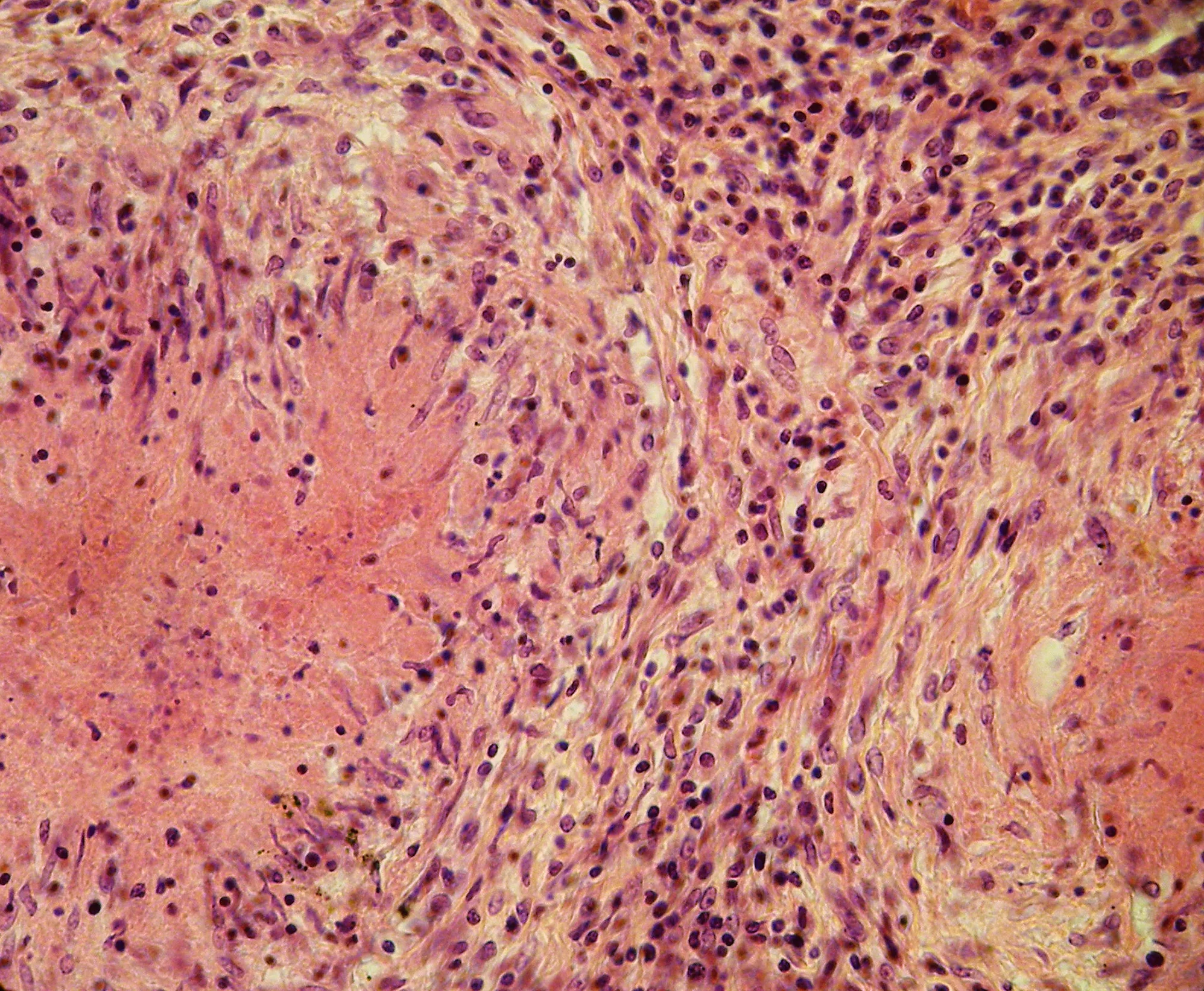 병리학 · Epithelioid cells in caseating tuberculous granuloma. Epithelioid cells gather around the focus of necrosis, in direct contact with the necrotic masses, forming a kind of boundary zone. Tissue s