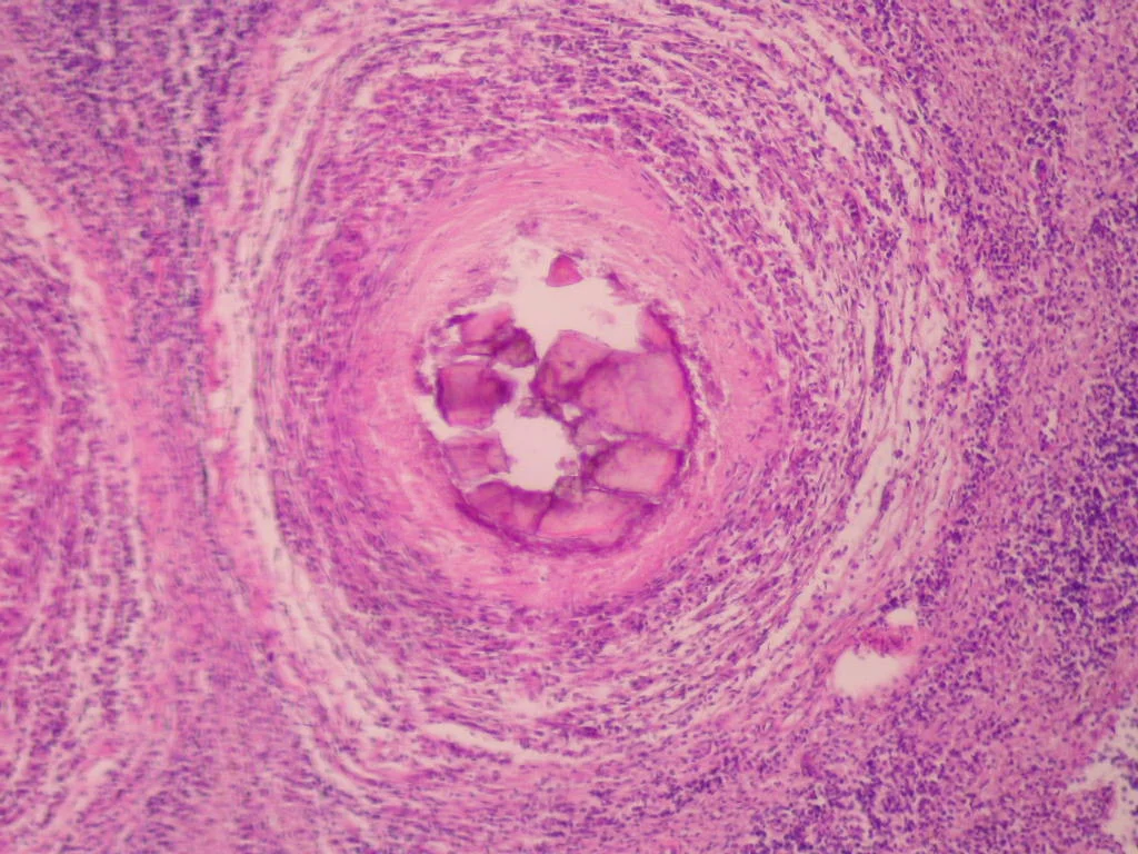 병리학 · granuloma con necrosi calcificazione e fibrosi