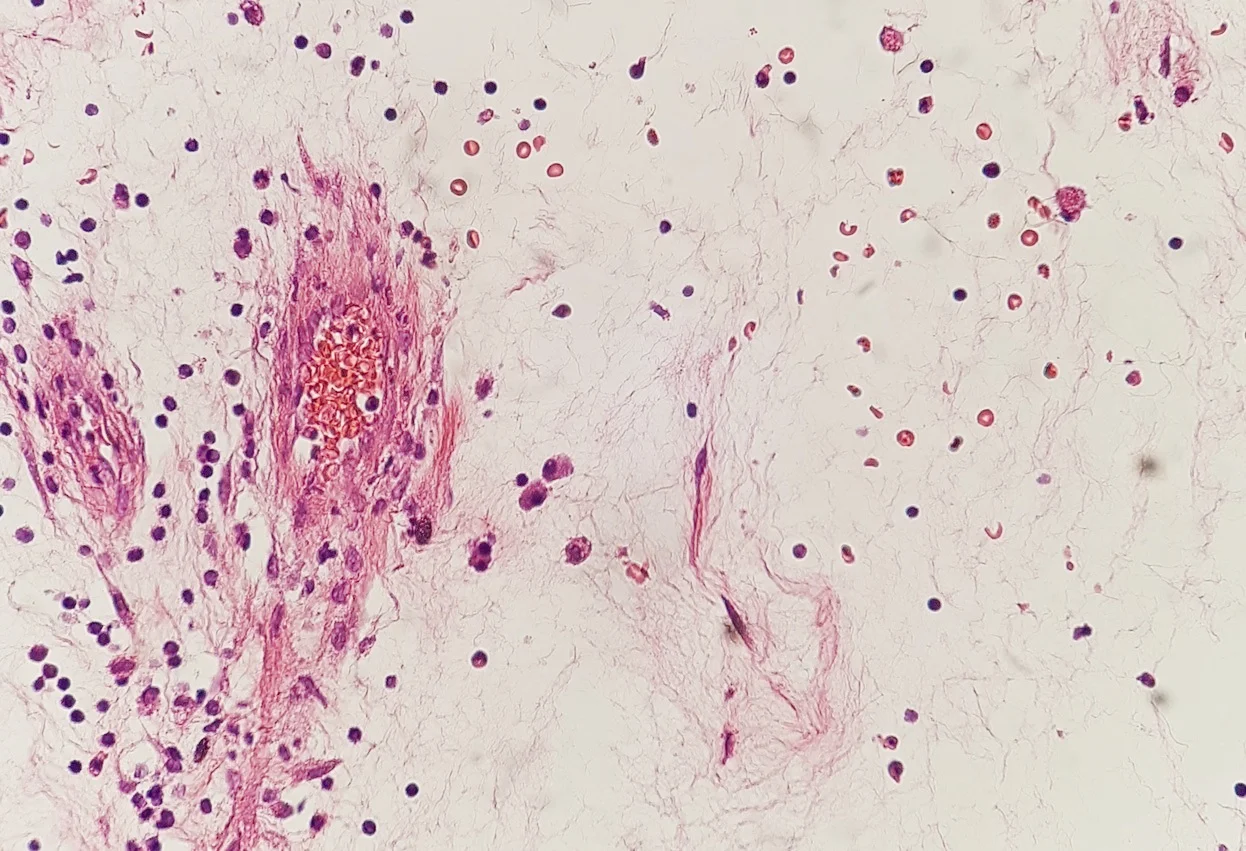 병리학 · Histopathology of edematous granulation tissue after previous excision of a squamous cell carcinoma . It shows sparse connective tissue with an inflammatory infiltrate, and blood vessels (at lef