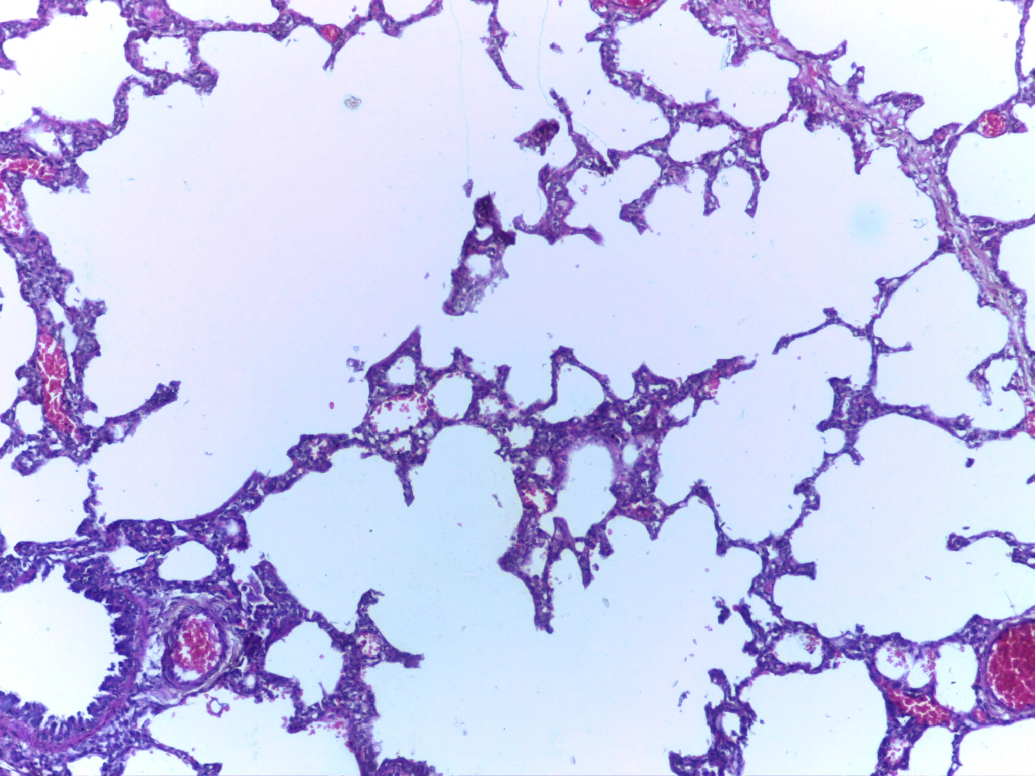 병리학 · Micrograph of empysema lung showing dialated, large alveoli separated by thin septa. Some septae are ruptured and appear to be floating in the alveloar spaces. Grossly emphysematous lung appears