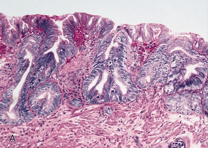 병리학 · ESOPHAGUS-STOMACH: BARRETT'S ESOPHAGUS WITH HIGH-GRADE DYSPLASIA: HISTOLOGIC SPECTRUM Low-power view showing marked distortion of the glandular architecture making it difficult to exclude intram
