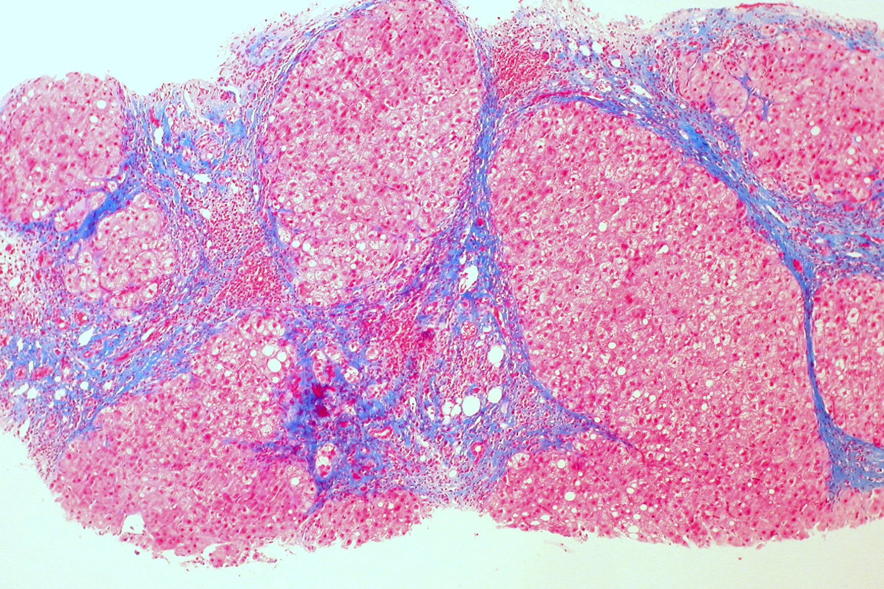 병리학 · Micrograph of a liver sample with trichrome stain , showing cirrhosis as a nodular texture surrounded by fibrosis (wherein collagen is stained blue). Pathological and histological images courtes
