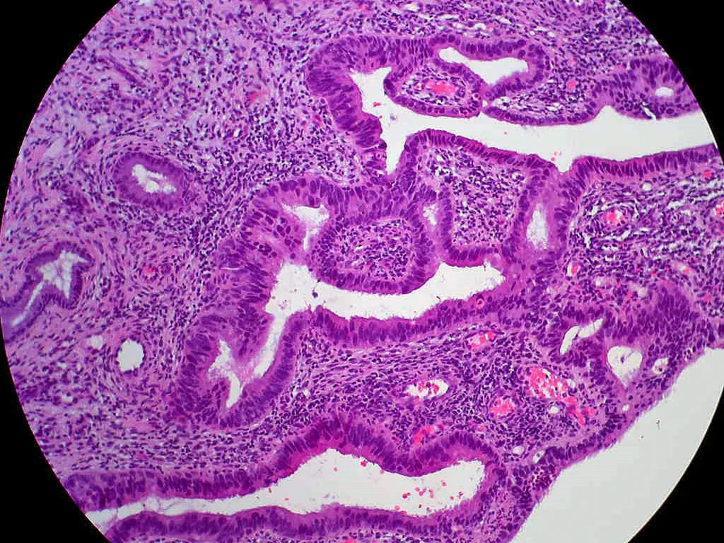 병리학 · Cervical biopsy showing adenocarcinoma in situ, which extensively involved multiple biopsies in the accession. Lesson: You can't trust liquid-based Paps to pick up glandular lesions! Pathologica