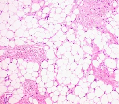병리학 · Histopathology of lipoma : The mass is composed of lobules of mature white adipose tissue divided by delicate and inconspicuous fibrous septa containing thin-walled capillary-sized vessels.(H&E,