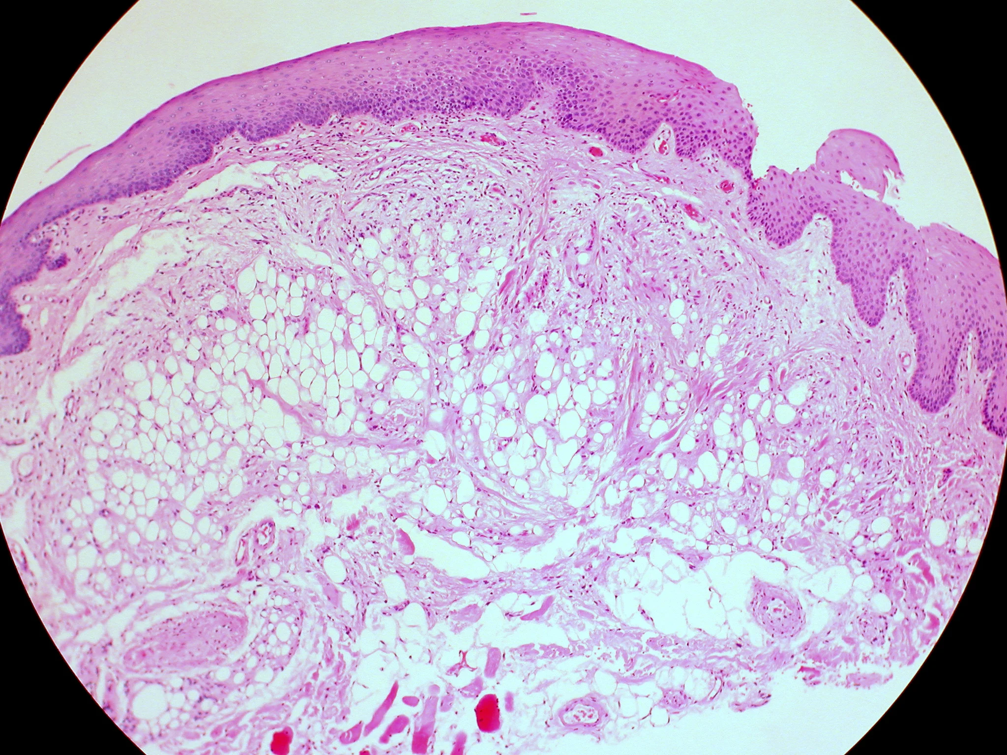 병리학 · I don't recall ever having seen one of these before. This was a 2-mm lesion from the lateral edge of te tongue. Mucosa is at the top, with a few skeletal muscle fibers at the bottom of the image