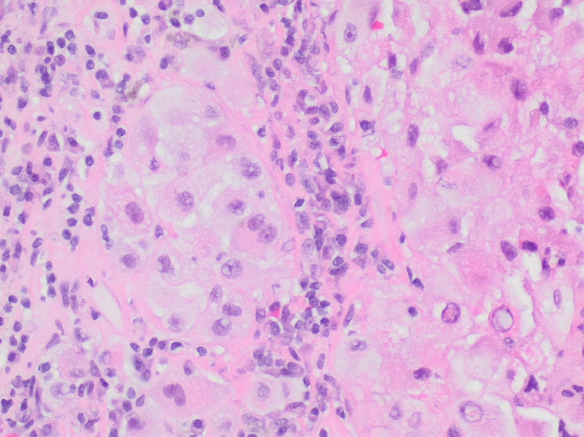 병리학 · Histopathology of a metastatic melanoma to a lymph node, H&E stain, showing poorly differentiated cells with high grade features. Immunohistochemistry was needed to establish the diagnosis (see 