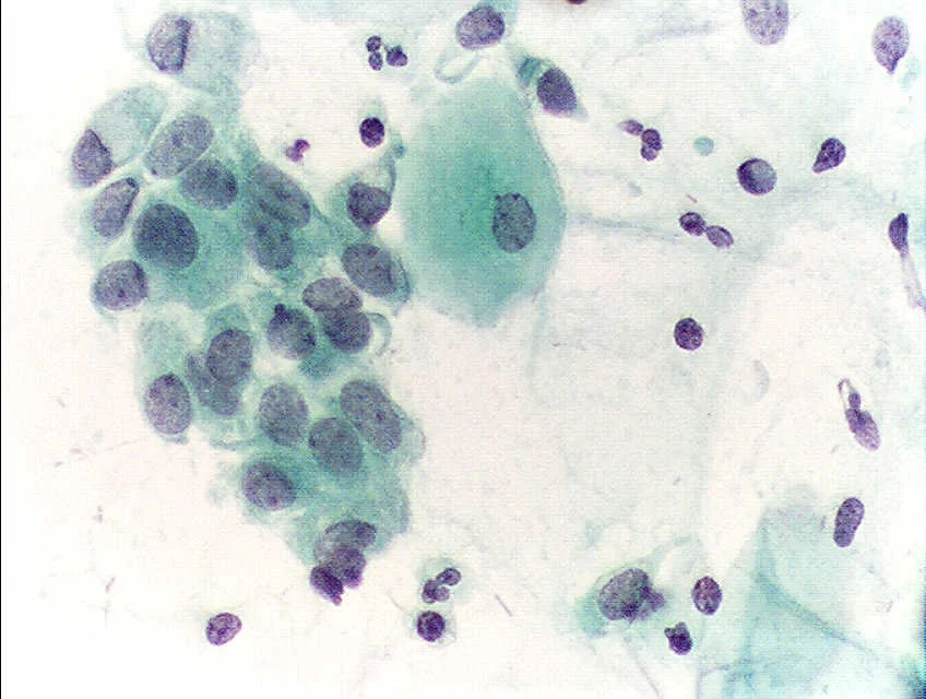 진단세포학 · Pap test, Papanicolau stain, 400x. Normal endocervical cells should be present into the slide, as a proof of a good quality sampling.