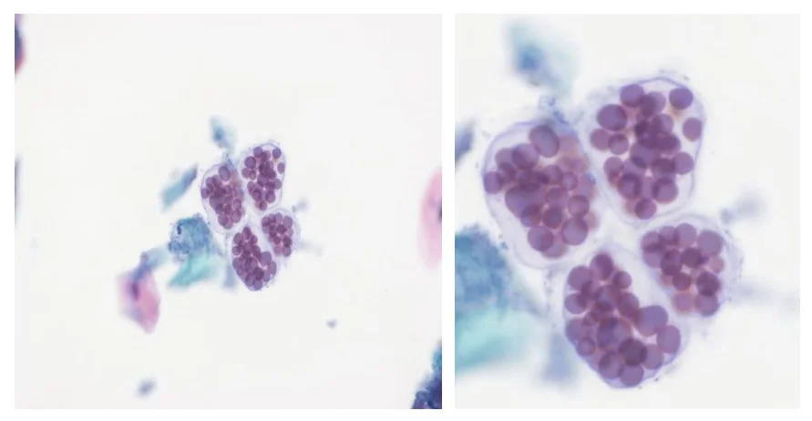 진단세포학 · These cells were detected in an anal Papanicolaou-stained smear. These are plant seed-derived storage cells whose cytoplasm is filled with numerous vacuoles that likely contain glycogen. Their