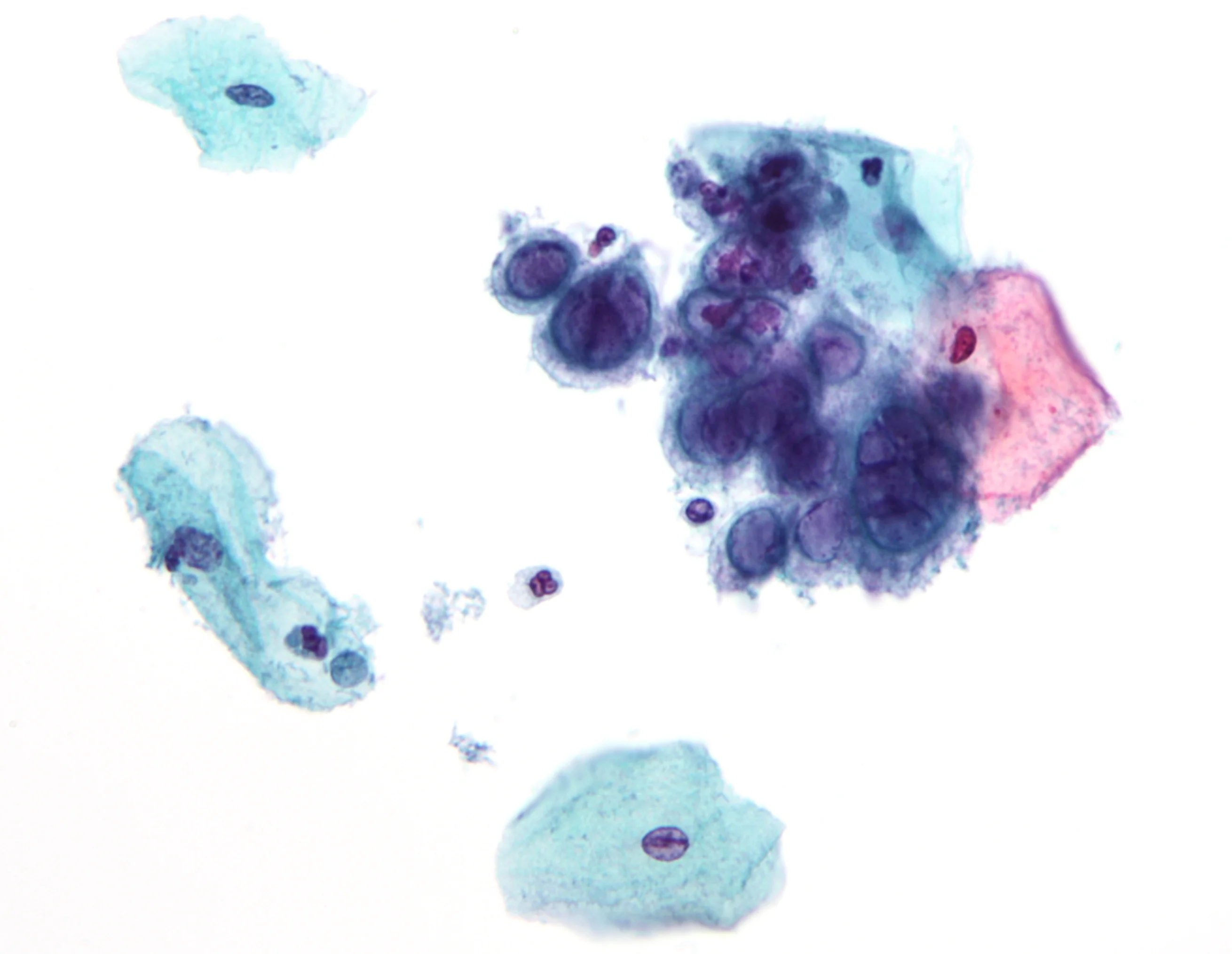 진단세포학 · Micrograph showing the changes of herpes simplex virus (HSV) . Pap test . Pap stain . The changes seen above may also been seen with the varicella zoster virus (VZV) .