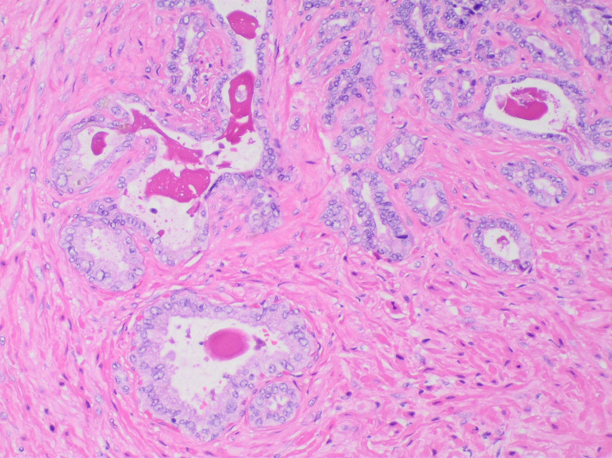조직검사학 · Histology of seminal vesicle glands on H&E stain. They may mimic prostatic adenocarcinoma by crowded glands with enlarged hyperchromatic and irregular nuclei, but will have inconspicuous nucle