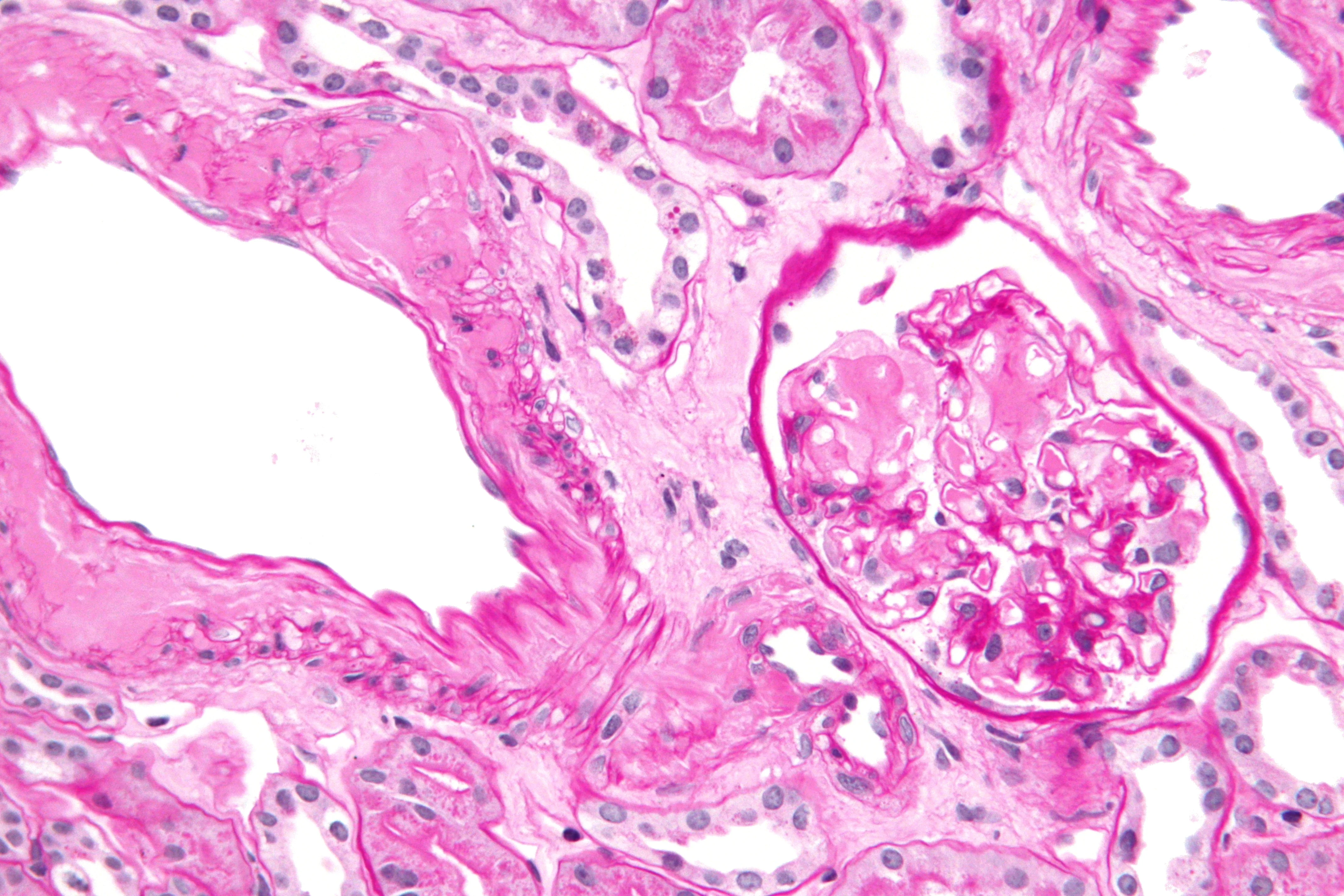 조직검사학 · Very high magnification micrograph of renal amyloidosis , also known as kidney amyloidosis and amyloidosis of the kidney . Kidney biopsy . PAS stain . Related images High mag. Very high mag. H