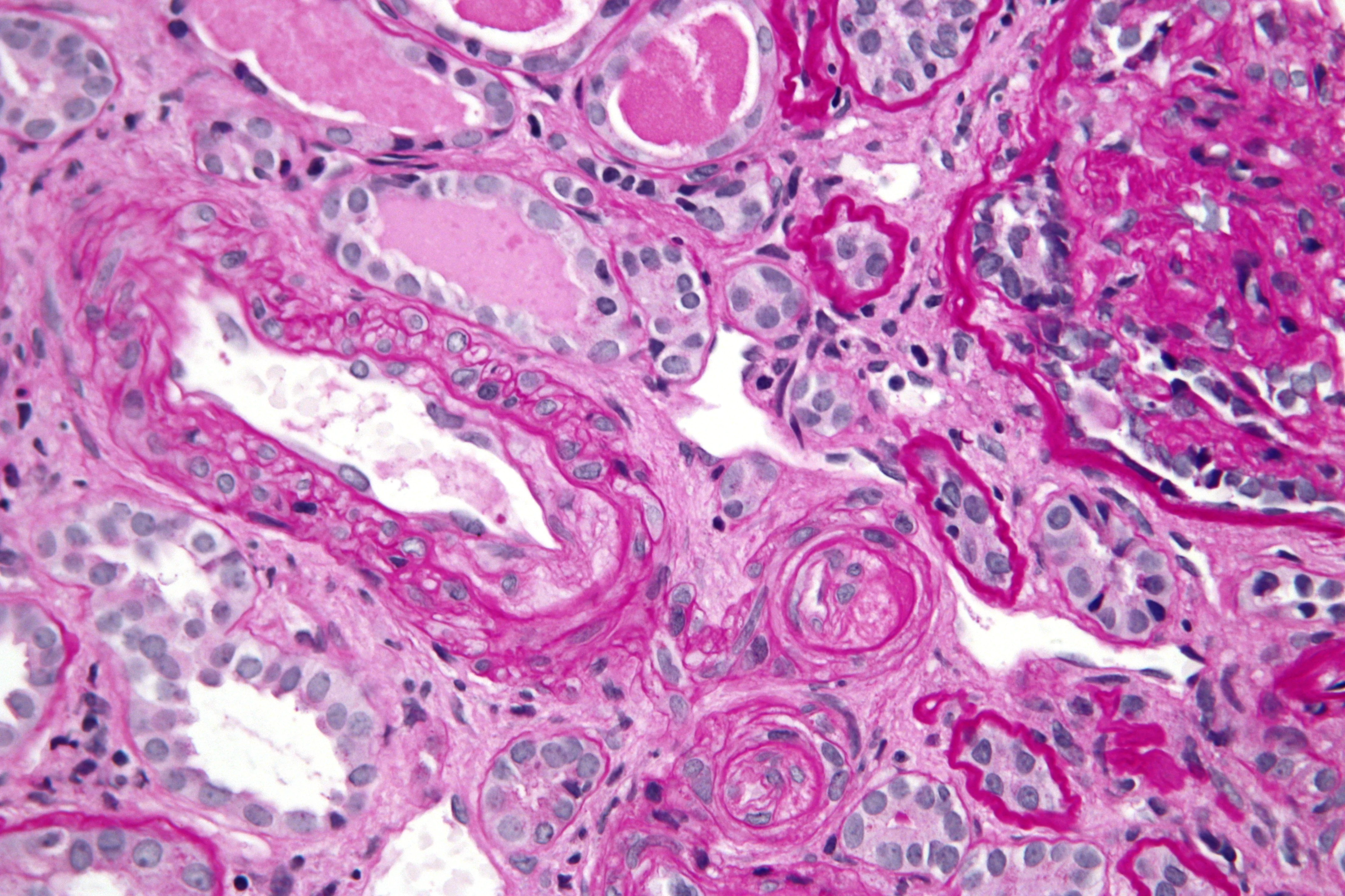 조직검사학 · Very high magnification micrograph of thrombotic microangiopathy , abbreviated TMA . Kidney biopsy . PAS stain . TMA as a broad differential diagnosis and includes: [ 1 ] Hemolytic uremic synd