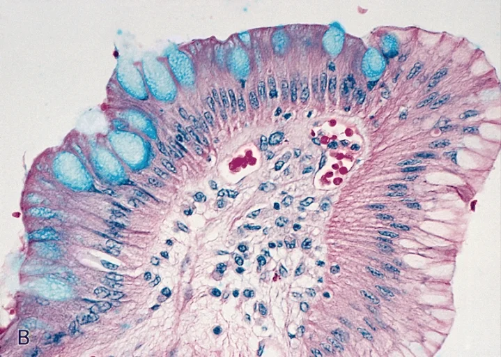 조직검사학 · ESOPHAGUS-STOMACH: MUCIN STAINS OF BARRETT'S MUCOSA Higher magnification of A shows the three cell types.
