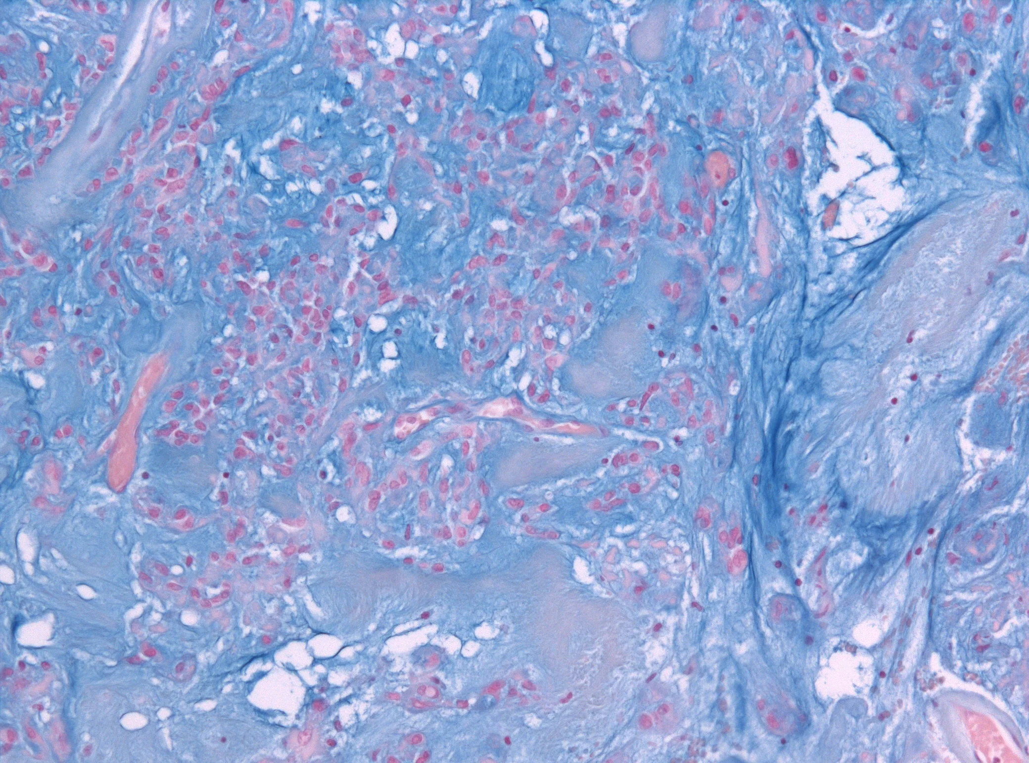 조직검사학 · Alcian blue staining of a histology specimen of a chordoid meningioma (x200 magnification)