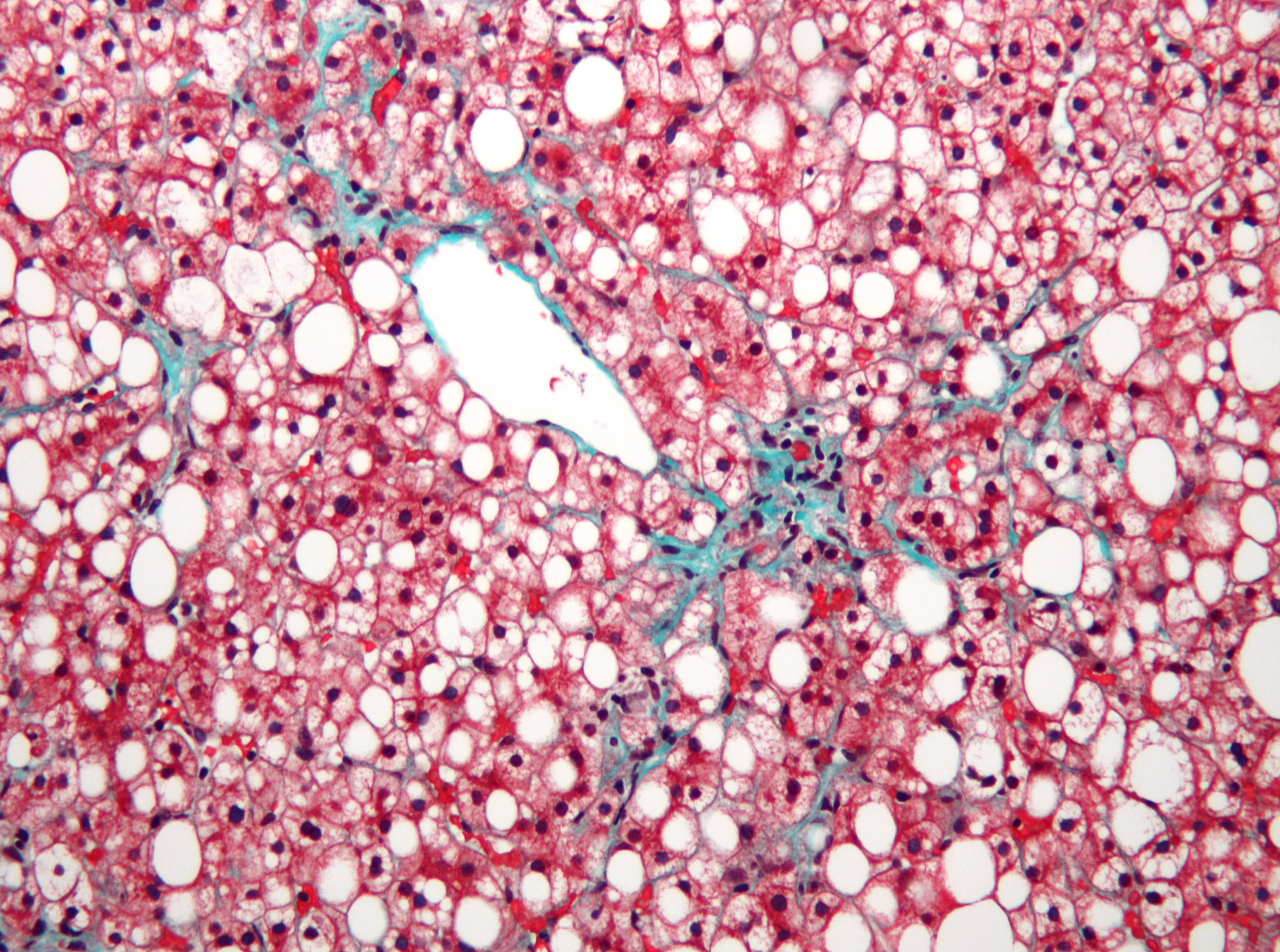 조직검사학 · Micrograph of non-alcoholic fatty liver disease ( NAFLD ) . Masson's trichrome & Verhoeff stain . The liver has a prominent (centrilobular) macrovesicular steatosis (white/clear round/oval spa