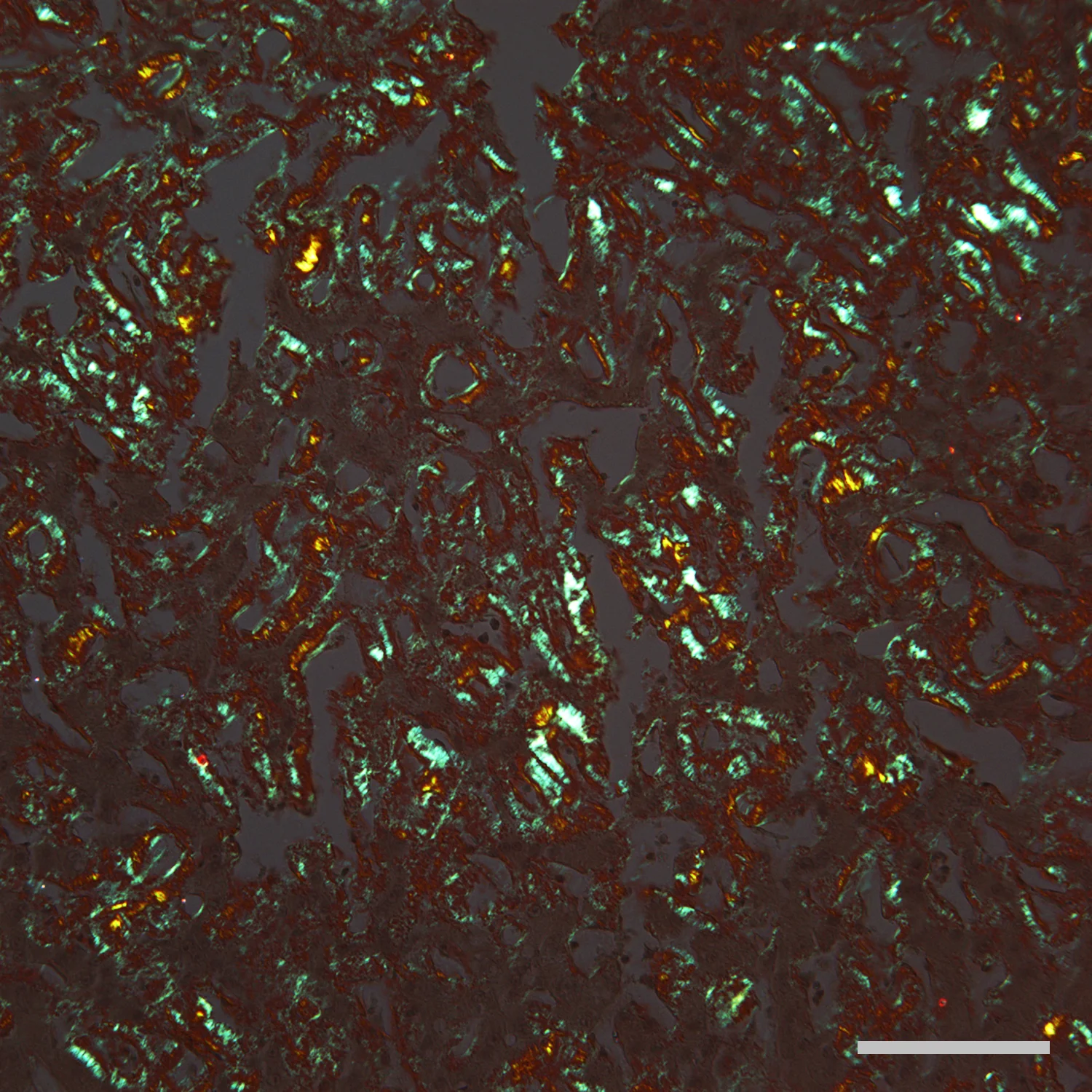 조직검사학 · Photomicrograph of amyloid in a thin section of liver that has been stained with the dye Congo Red. When viewed with crossed polarizing light filters, amyloid glows with a typical orange-green